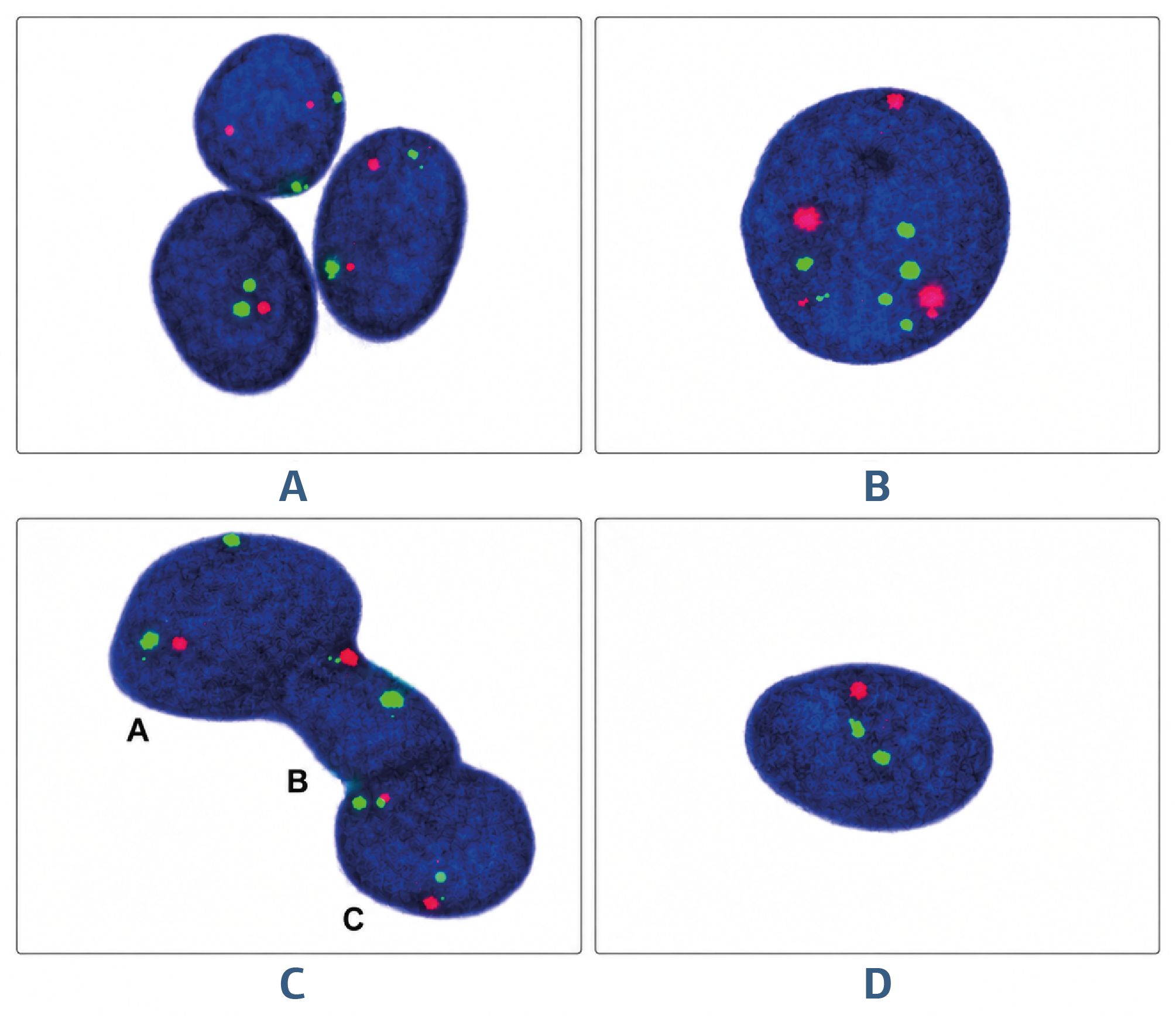 Figure 1. iFISH images of the samples of bronchoalveolar lavage fluids collected from the patient group diagnosed with non-small cell lung cancer (A-D). A) One cell containing a 3G3R signal from a case with adenocarcinoma. B) One atypical cell containing a signal (6G3R) from a case with adenocarcinoma. C) One cell containing an atypical signal (1G2R) from a case with squamous cell lung cancer. D) A case with squamous cell lung cancer showing most cells with atypical signals (1G2R). Magnification: x100.