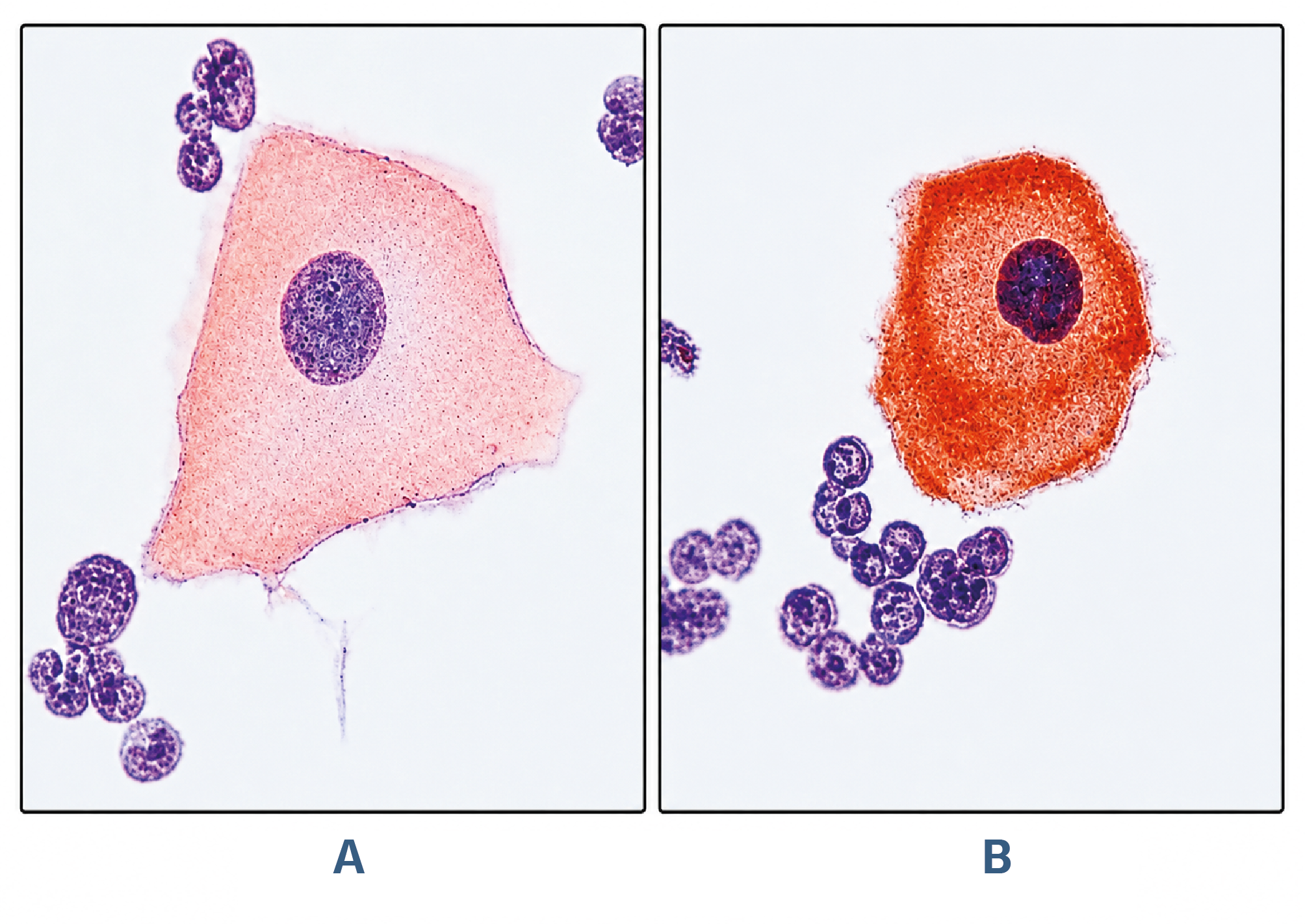 Figure 2. Micrographs of immunostaining for PTEN in the samples of bronchoalveolar lavage fluids collected from the control group (A) and the patient group diagnosed with nonsmall cell lung cancer (B). A) An epithelial cell from the control group, having an apparent nucleus and cytoplasm. B) PTEN (+) staining is observed in occasional parts of the heterochromatin regions in the nucleus (→). Counterstaining: Hematoxylin (x100).