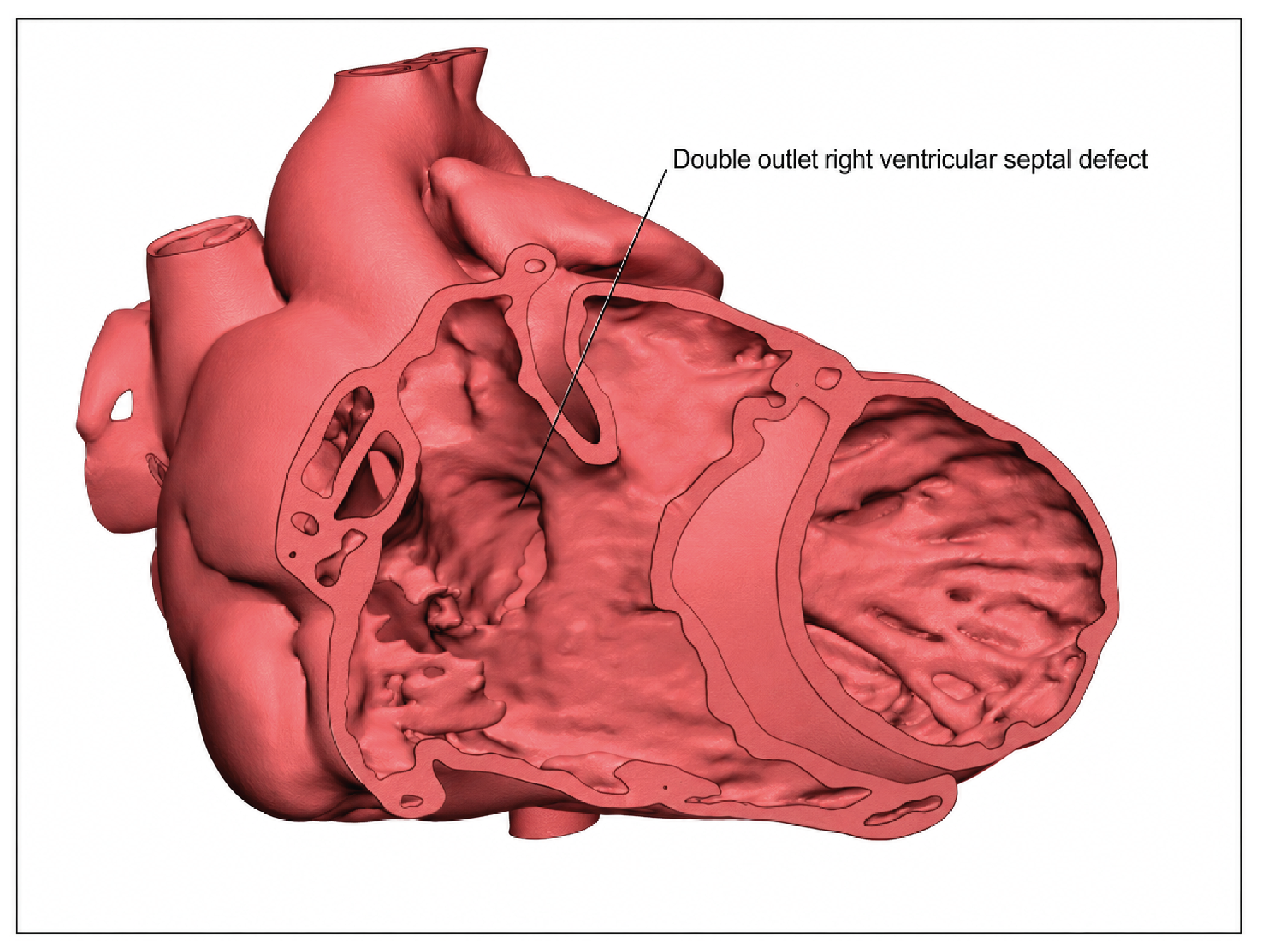 Figure 2. Double outlet right ventricle defect according to from CT images