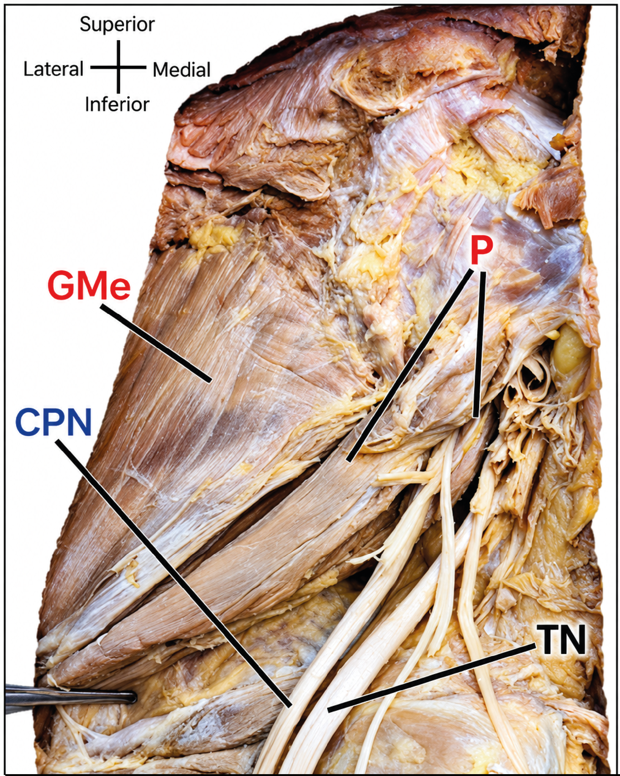 Figure 1. The Relationship of the Terminal Branches of the Sciatic Nerve in A Left Lower Limb with the Piriformis