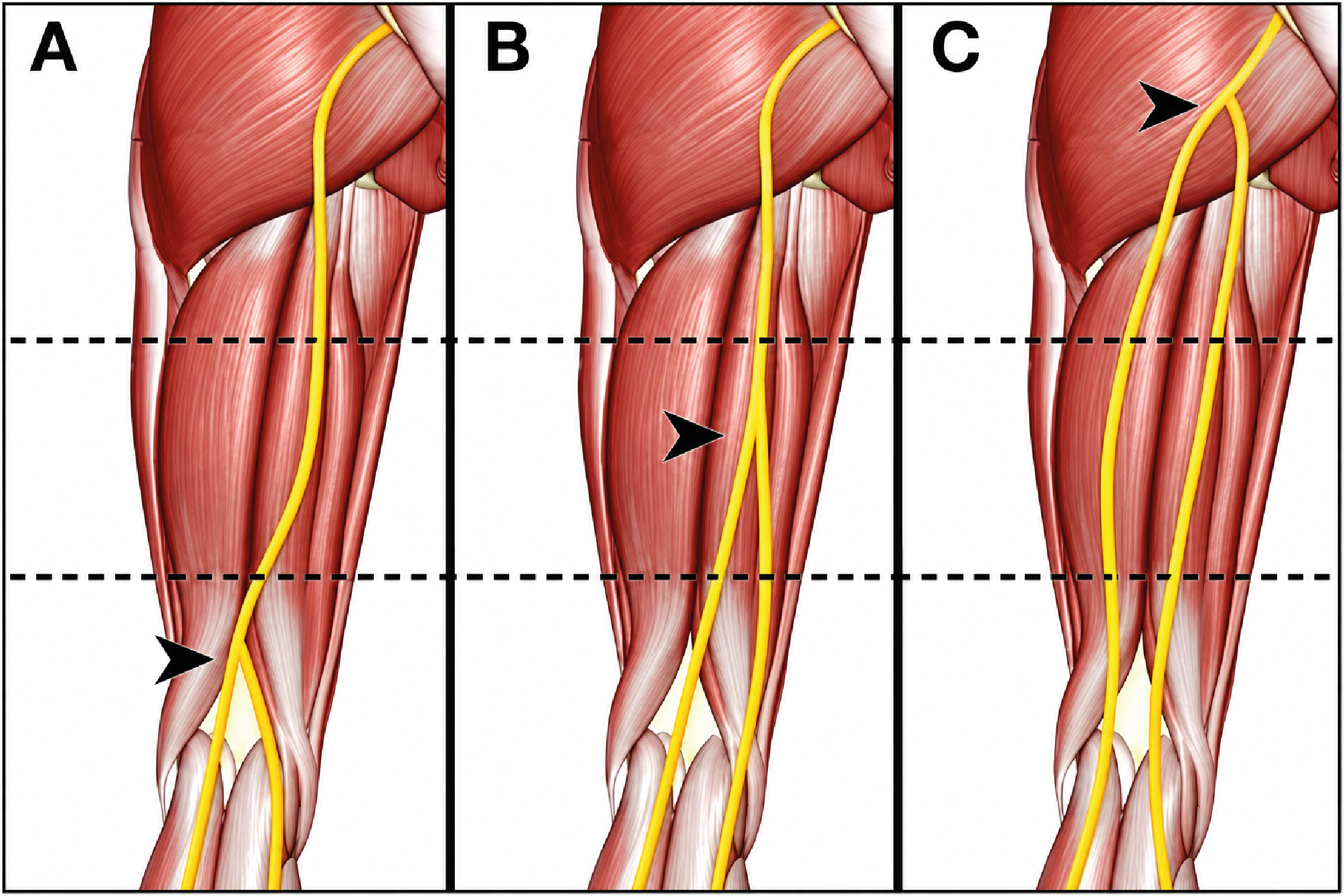 Figure 2. Sciatic Nerve Bifurcation Levels