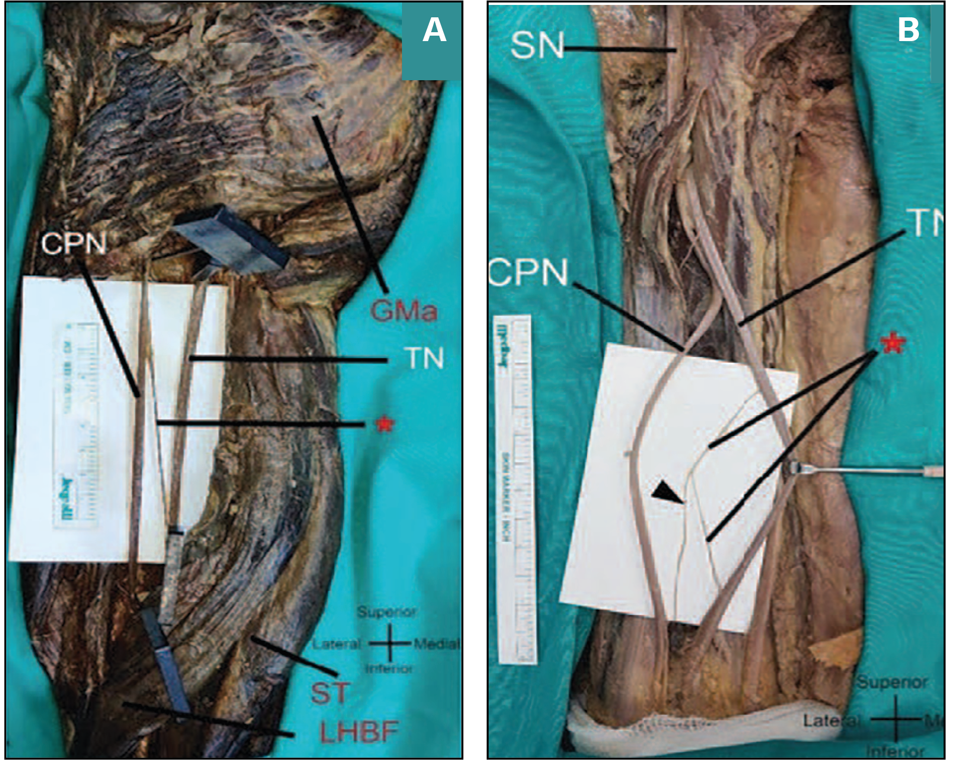 Figure 3. Connections (*) between the Terminal Branches of the Sciatic Nerve (SN)