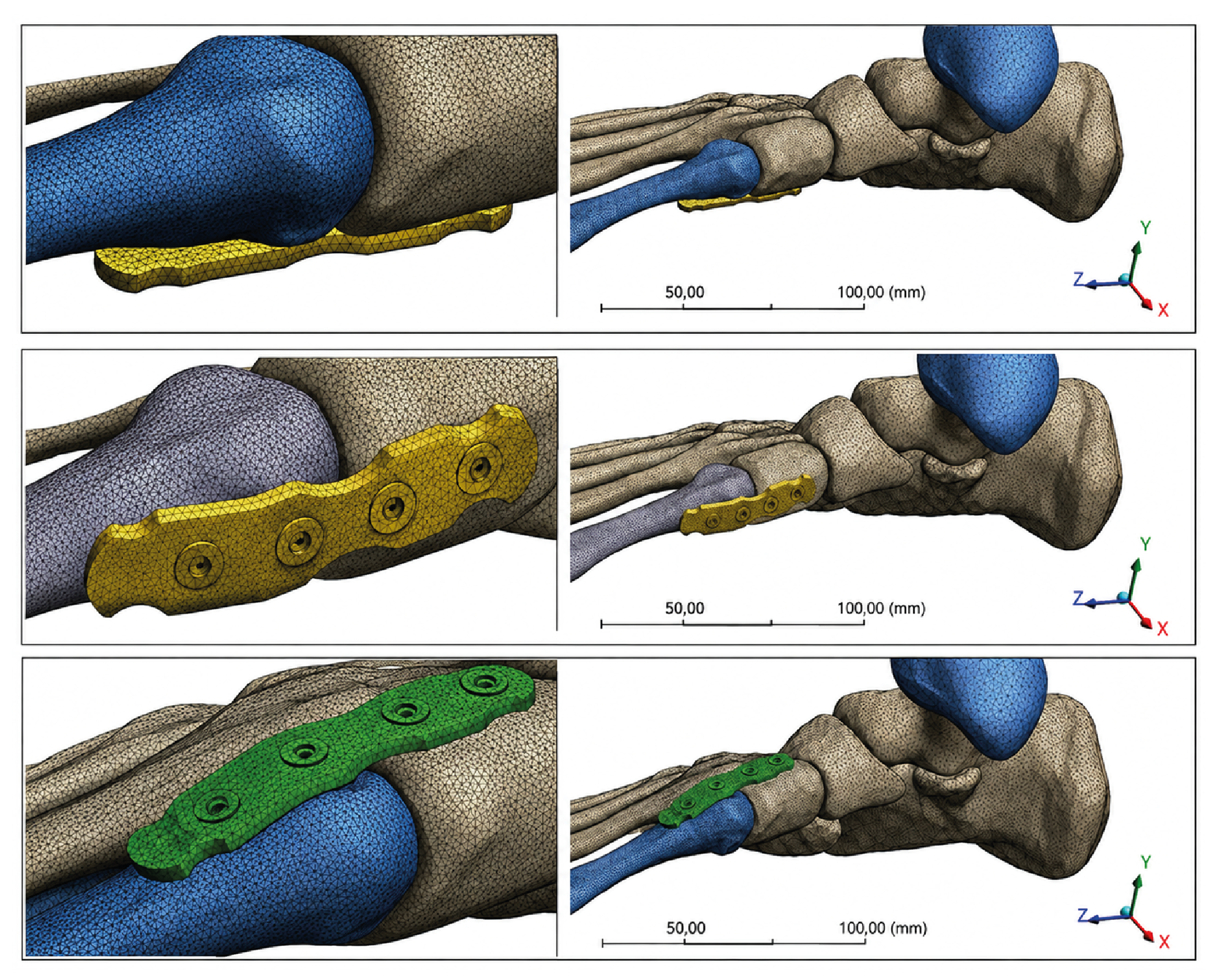 Figure 1. The Finite Element Model of Volar, Medial, and Dorsal Plates in Lapidus Arthrodesis