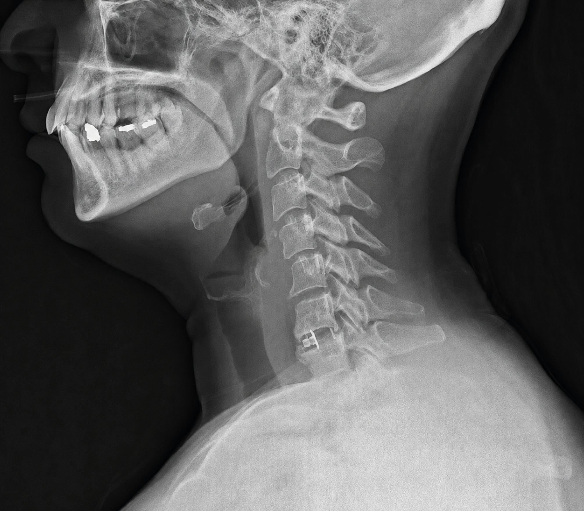 Figure 1. Lateral cervical radiograph of a patient who underwent C5-6 anterior cervical discectomy and ACDF