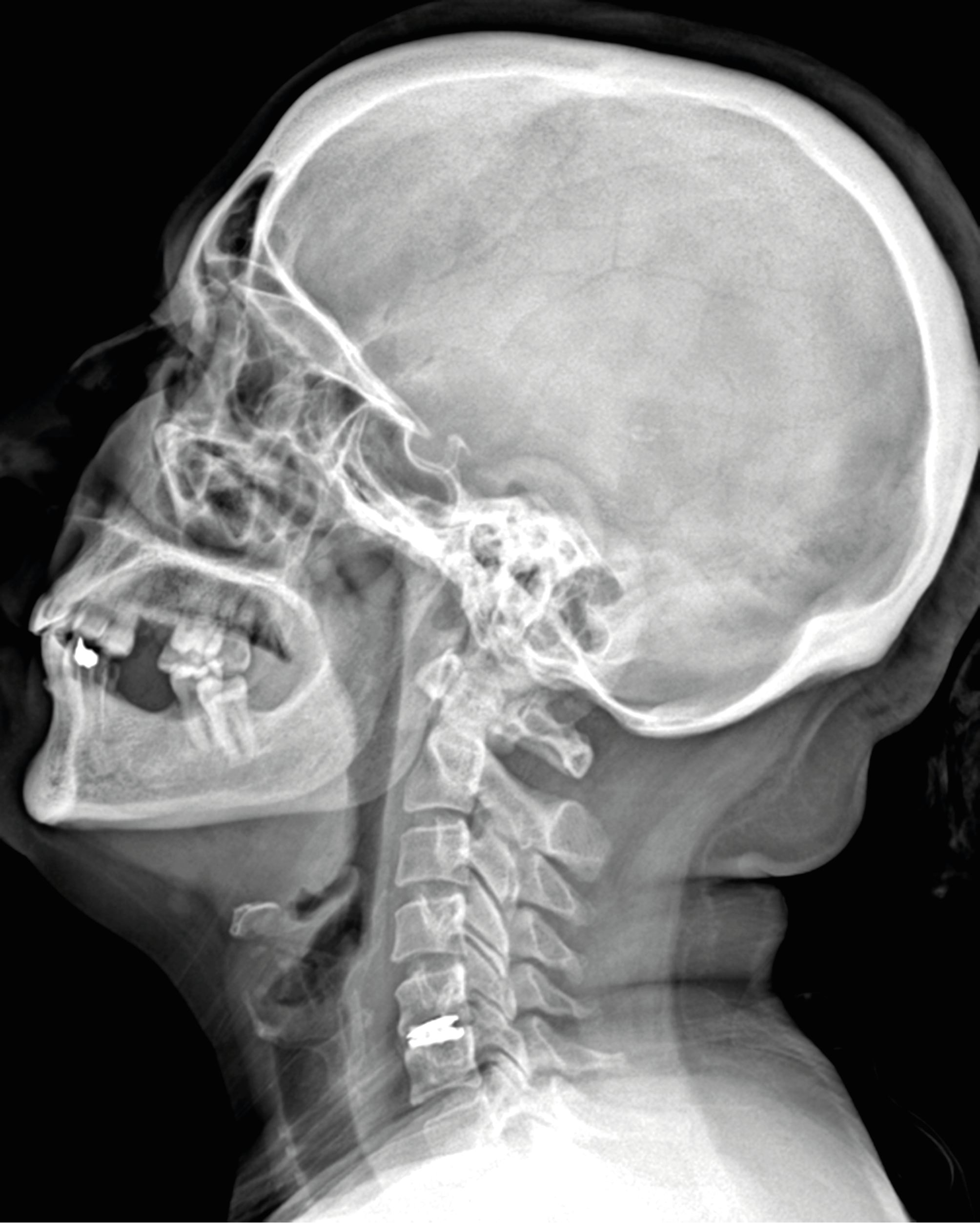 Figure 2. Lateral Cervical Radiograph of A Patient Who Underwent C5-6 Anterior Cervical Discectomy and CDP
