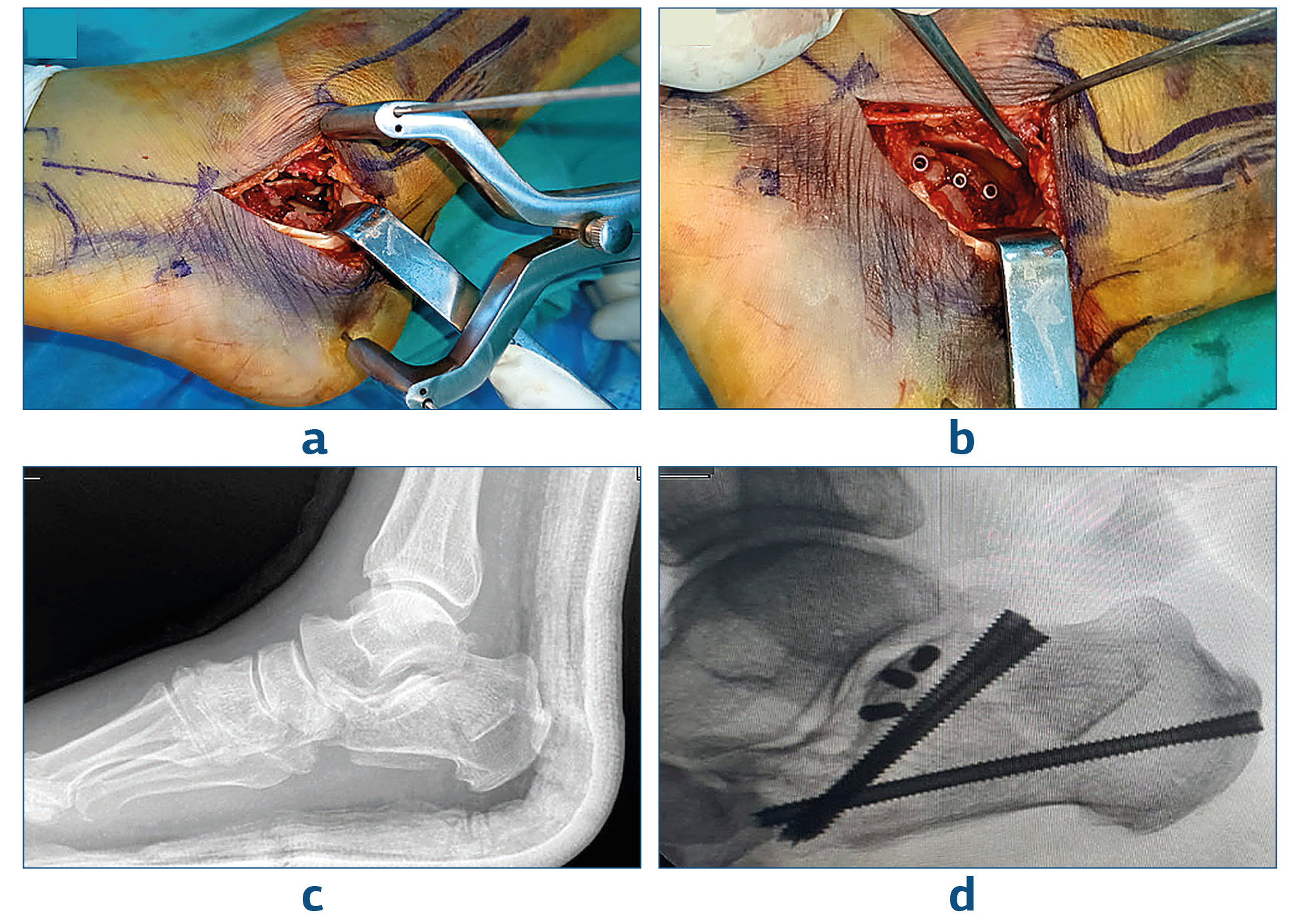 Figure 1. Perop Images of a Patient Operated by ST Approach