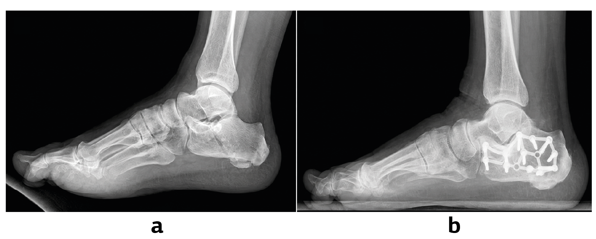 Figure 2. Patient Operated with LE Approach