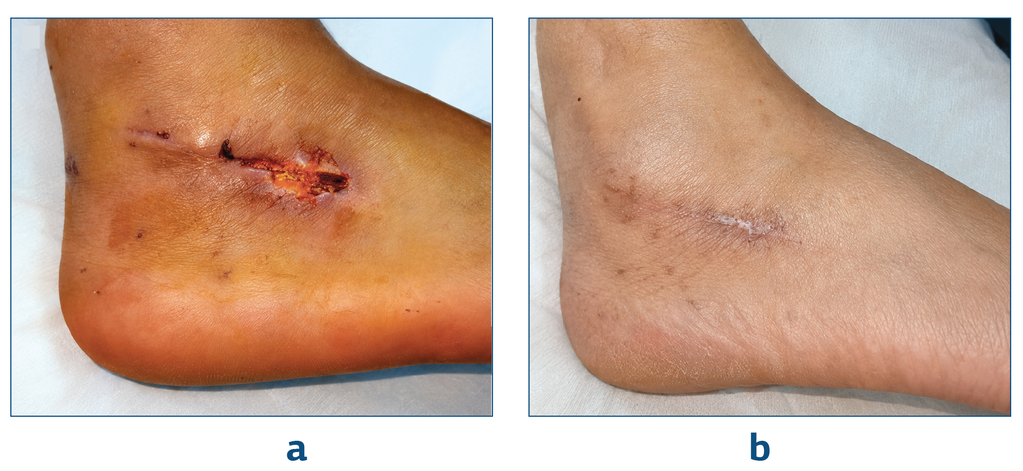 Figure 3. Patient with Superficial Wound Site Problem Operated Through ST Approach