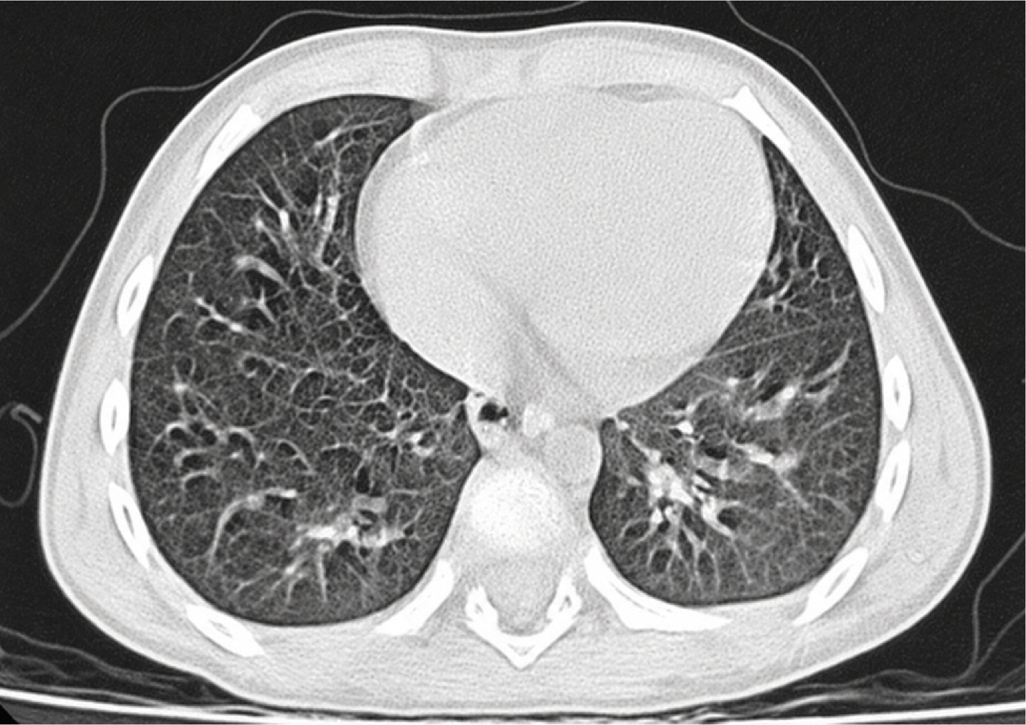 Figure 2. Chest CT Scan was Normal