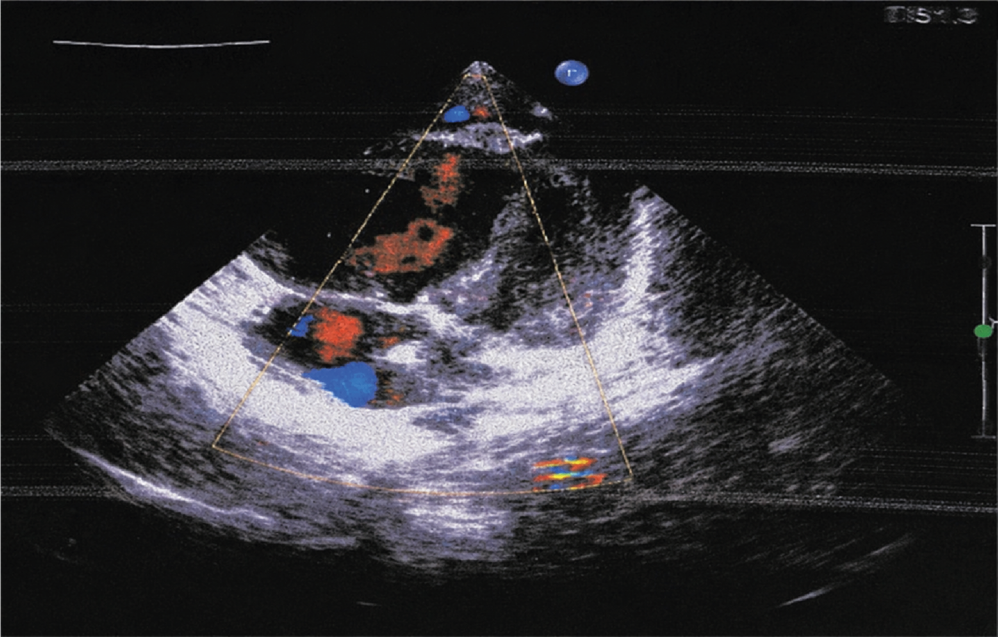 Figure 3. Dilated Right Ventricle