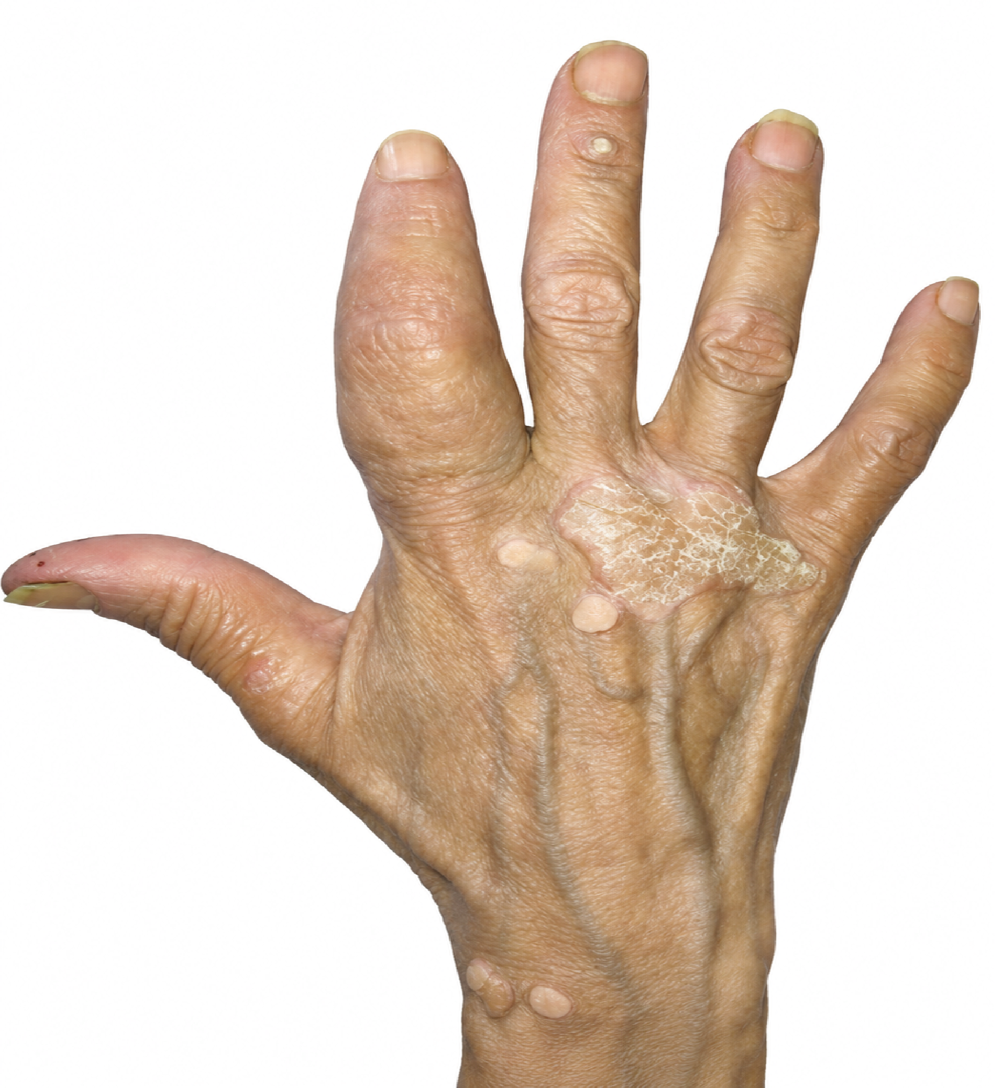 Figure 1. The Swollen Finger of the Patient