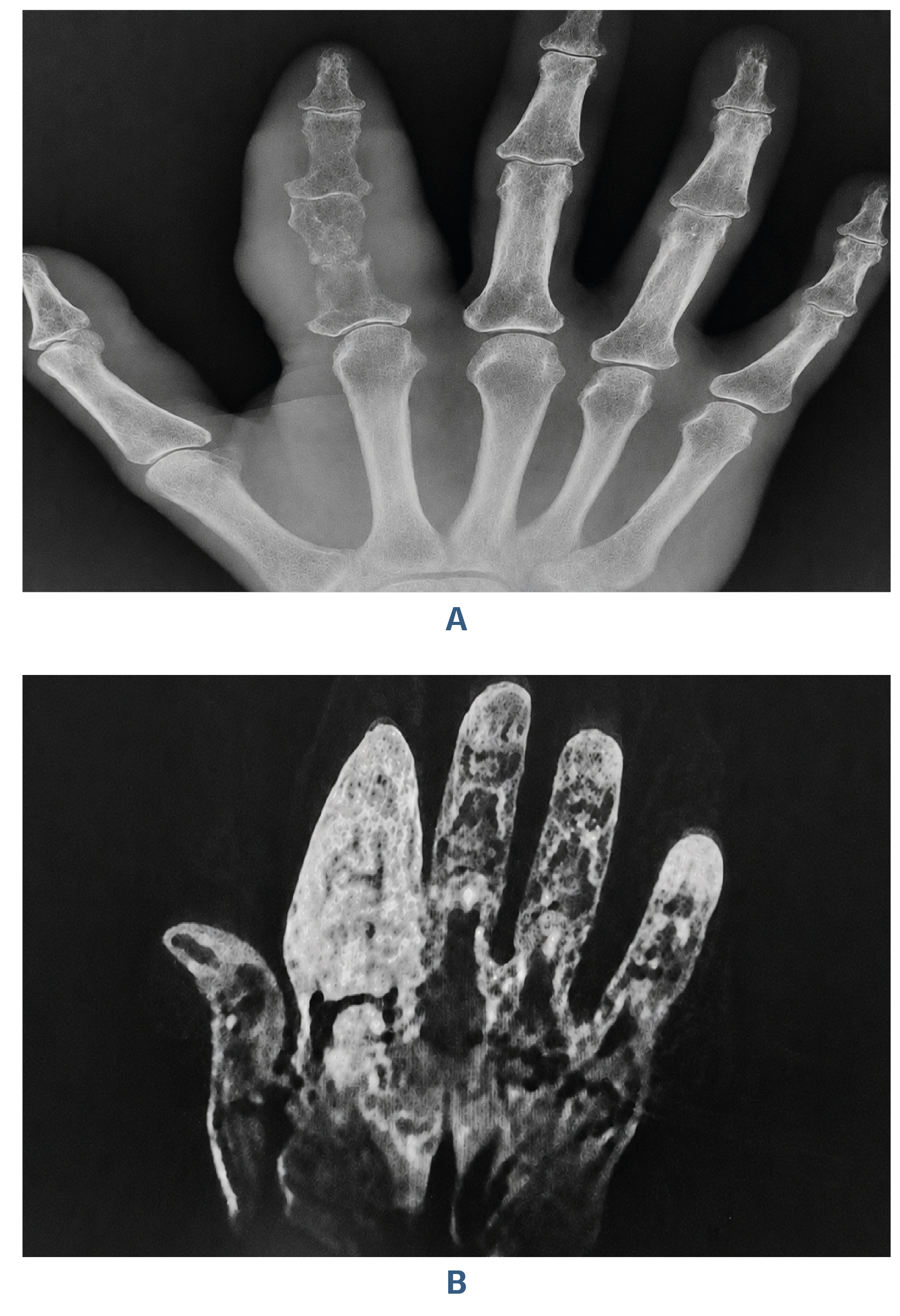 Figure 2. X- RAY of the Hand