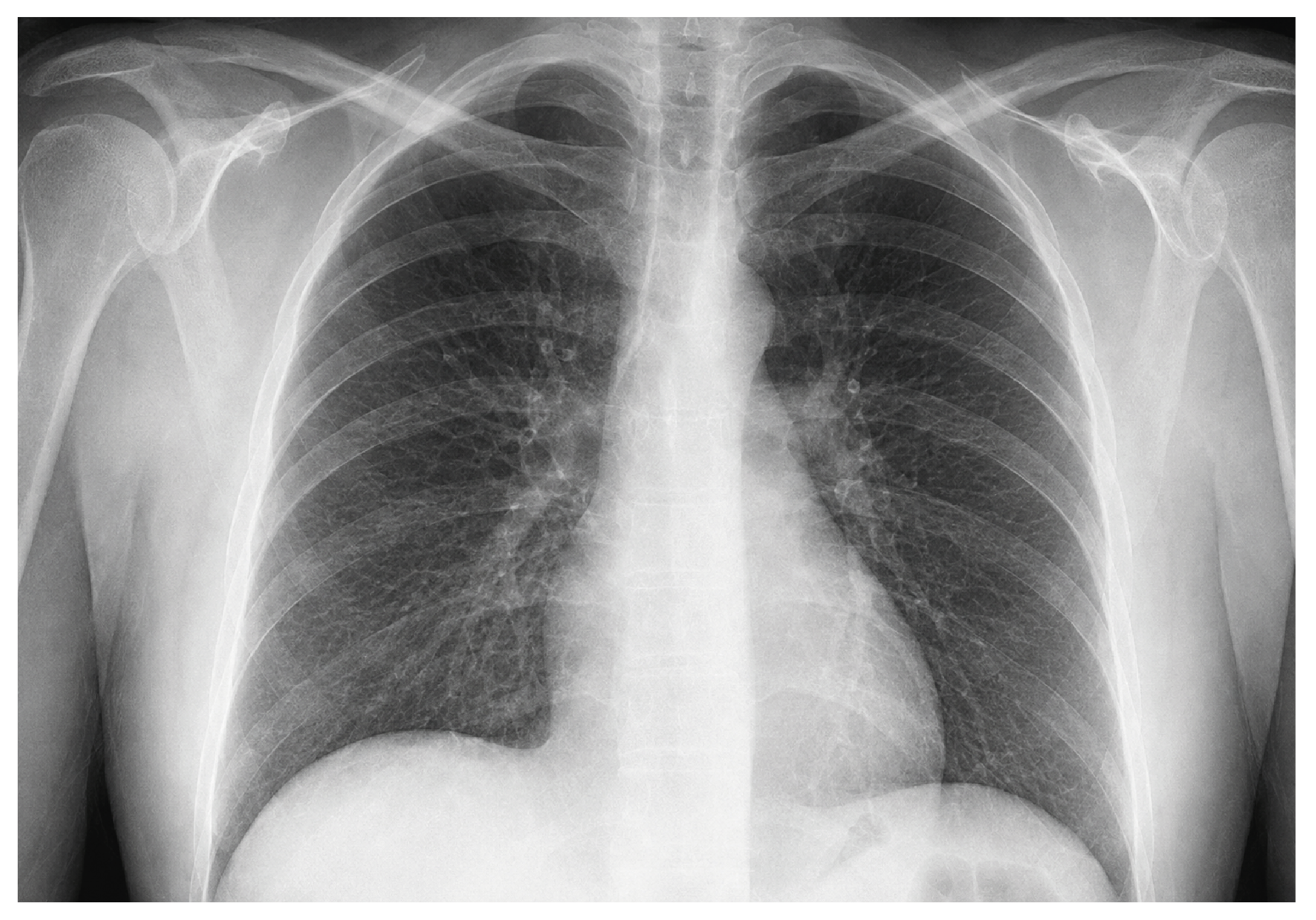 Figure 3. Chest X-ray, Bilateral Hilar Lymphadenopathy
