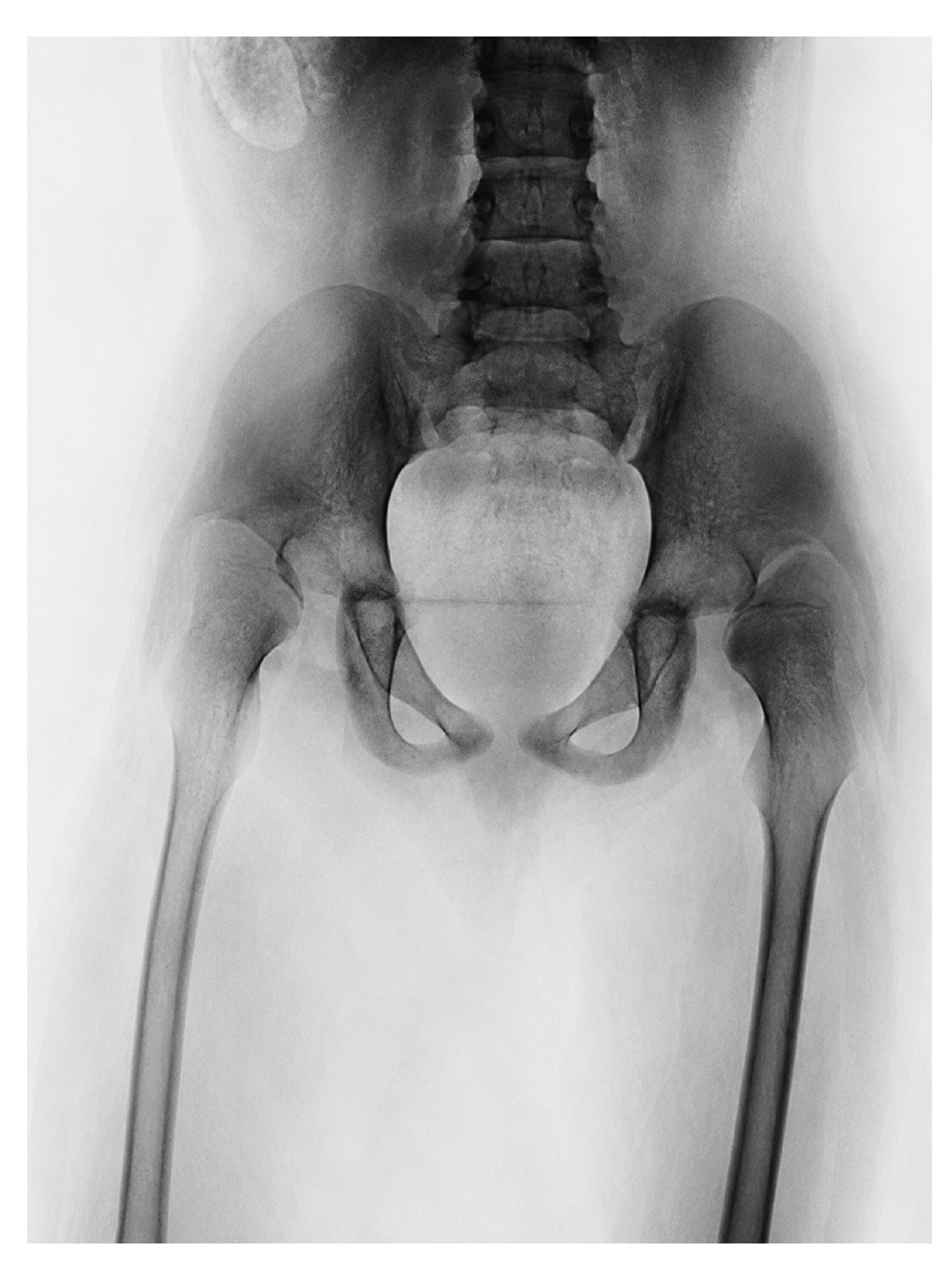 Figure 1. Preoperative X Ray