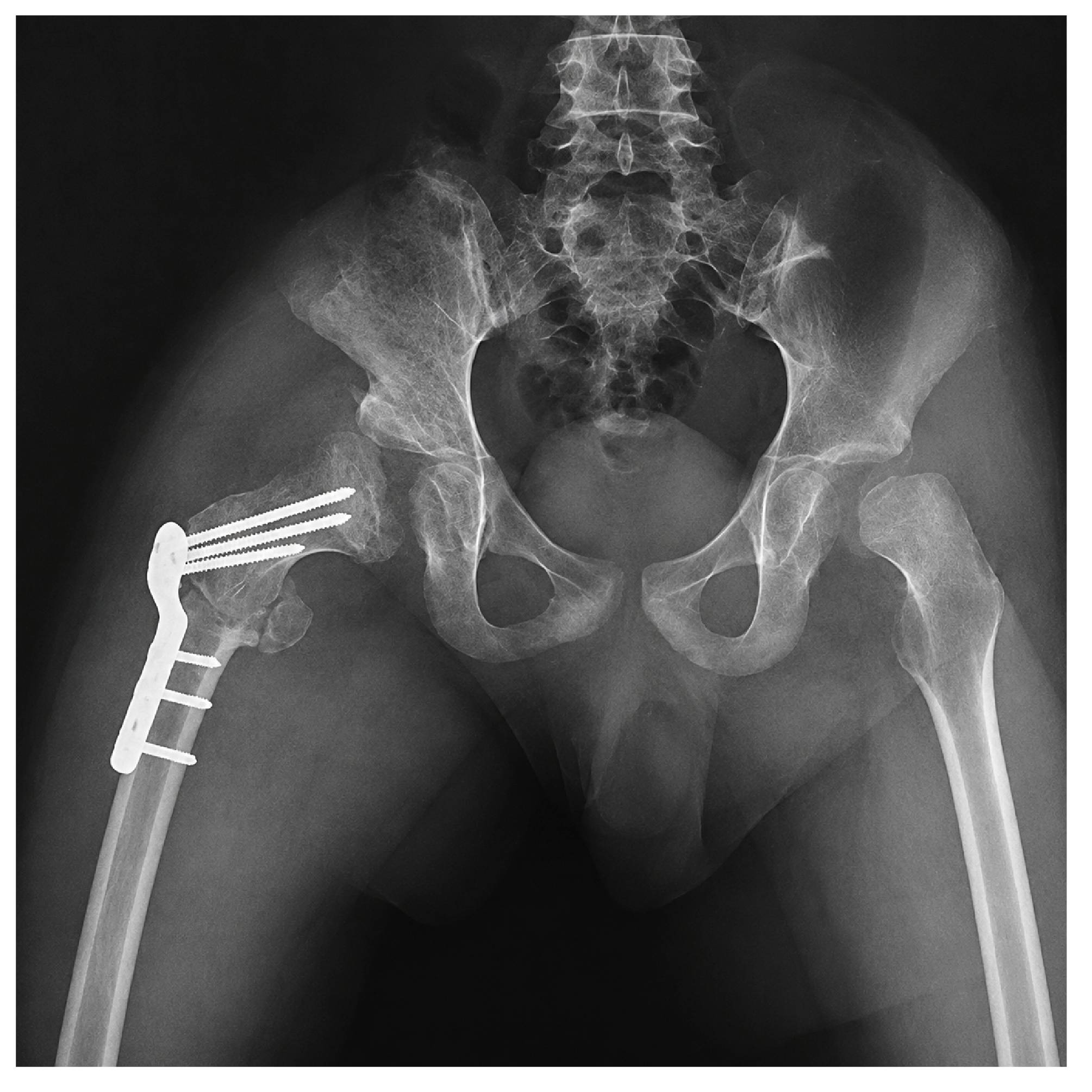 Figure 2. Postoperative X Ray