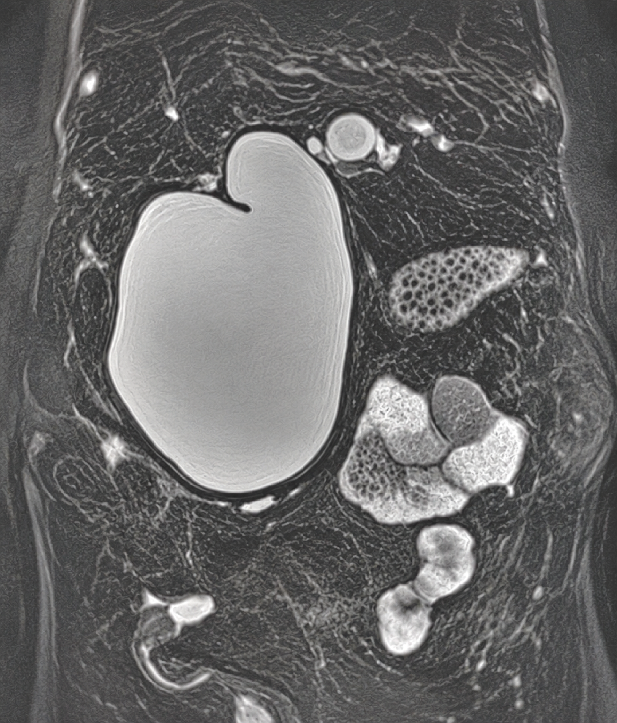 Figure 1. Coronal Section of the 3D BILI Sequence on MRI