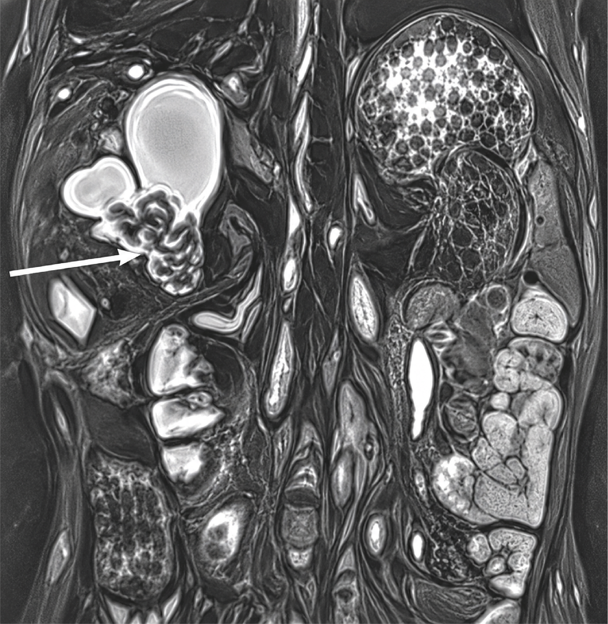 Figure 2. Coronal Section of the 3D BILI Sequence on MRI