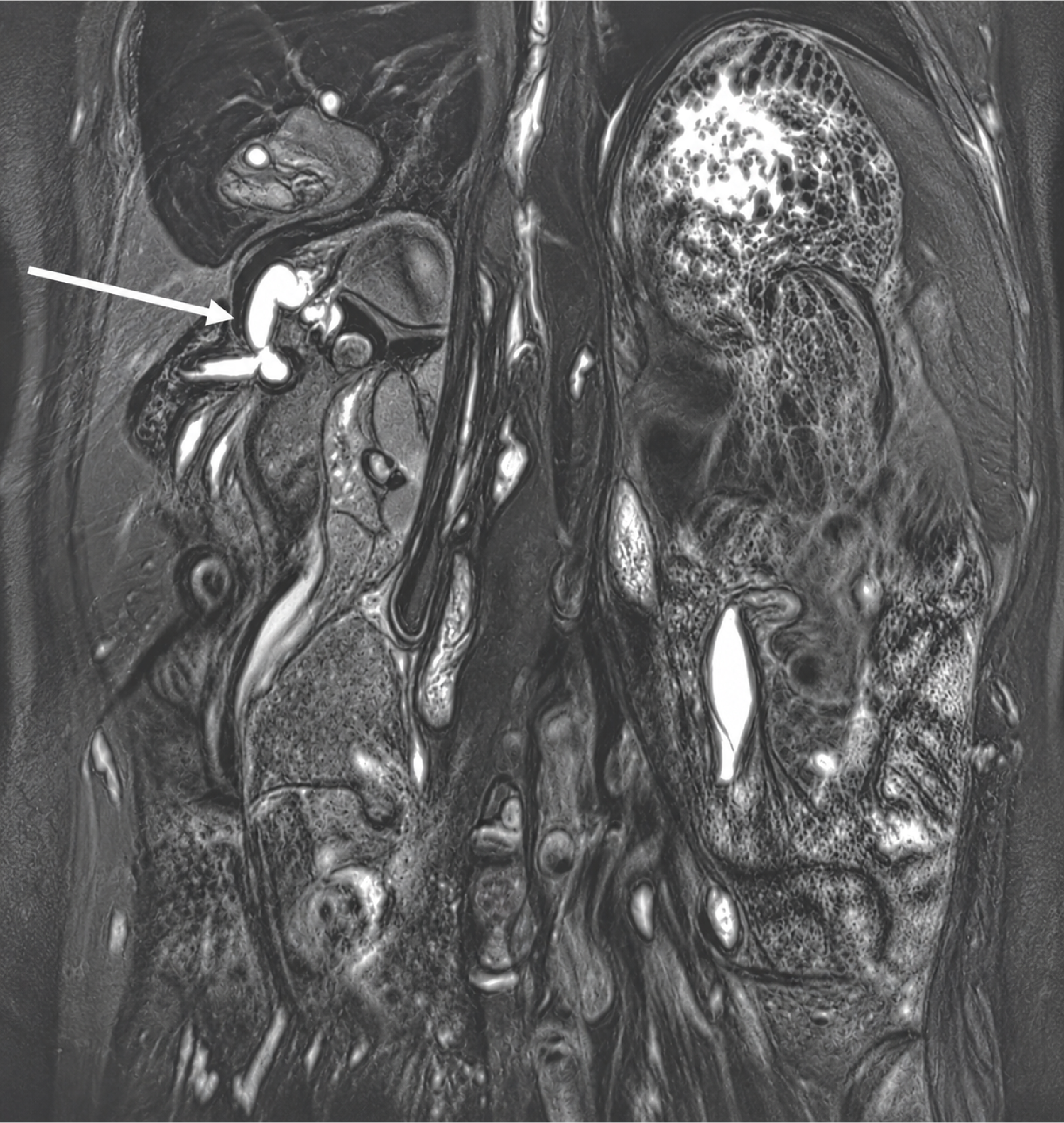 Figure 3. Coronal Section of the 3D BILI Sequence on MRI
