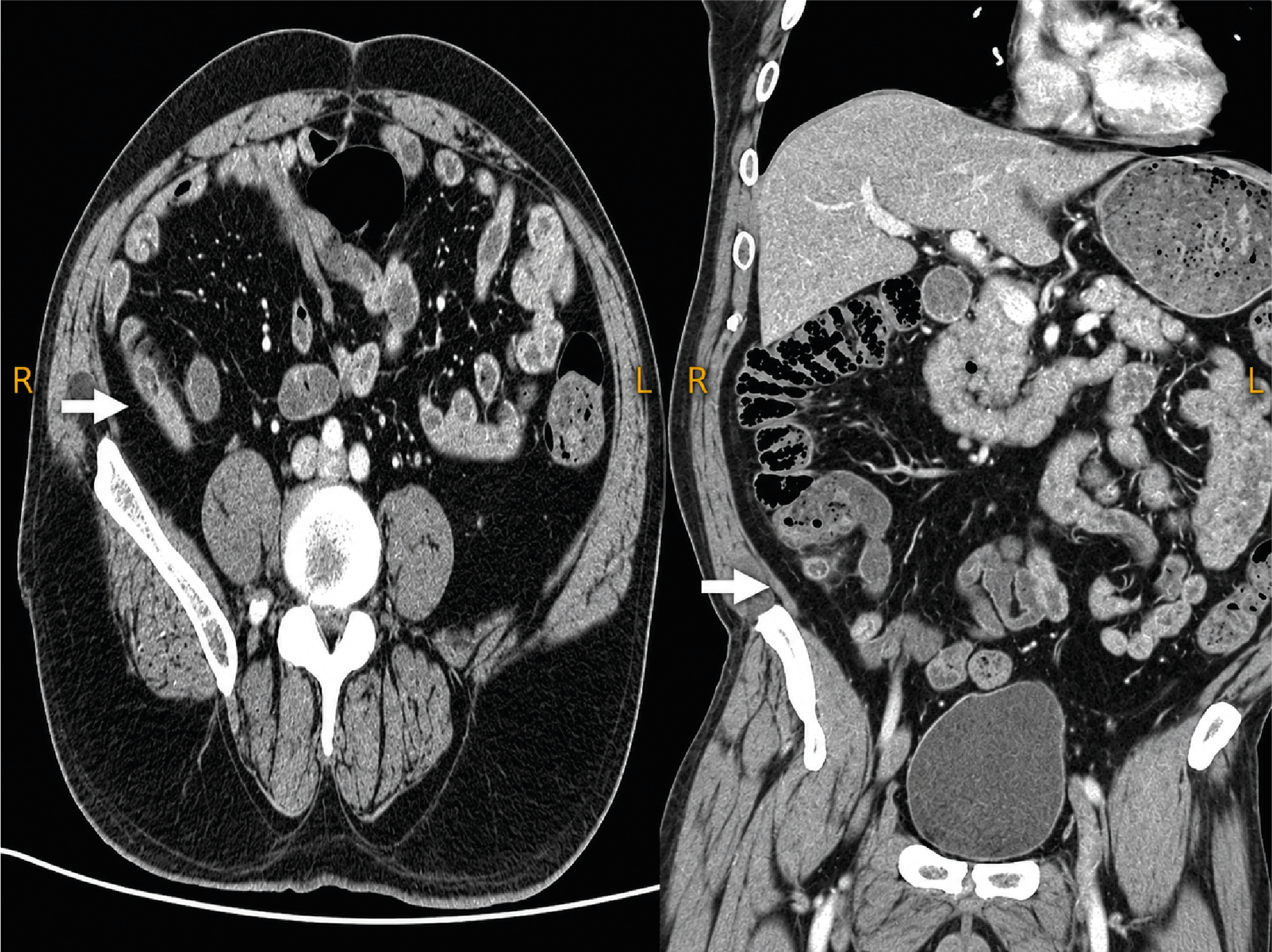Figure 1. Appendix View in Axial Section and Coronal Section