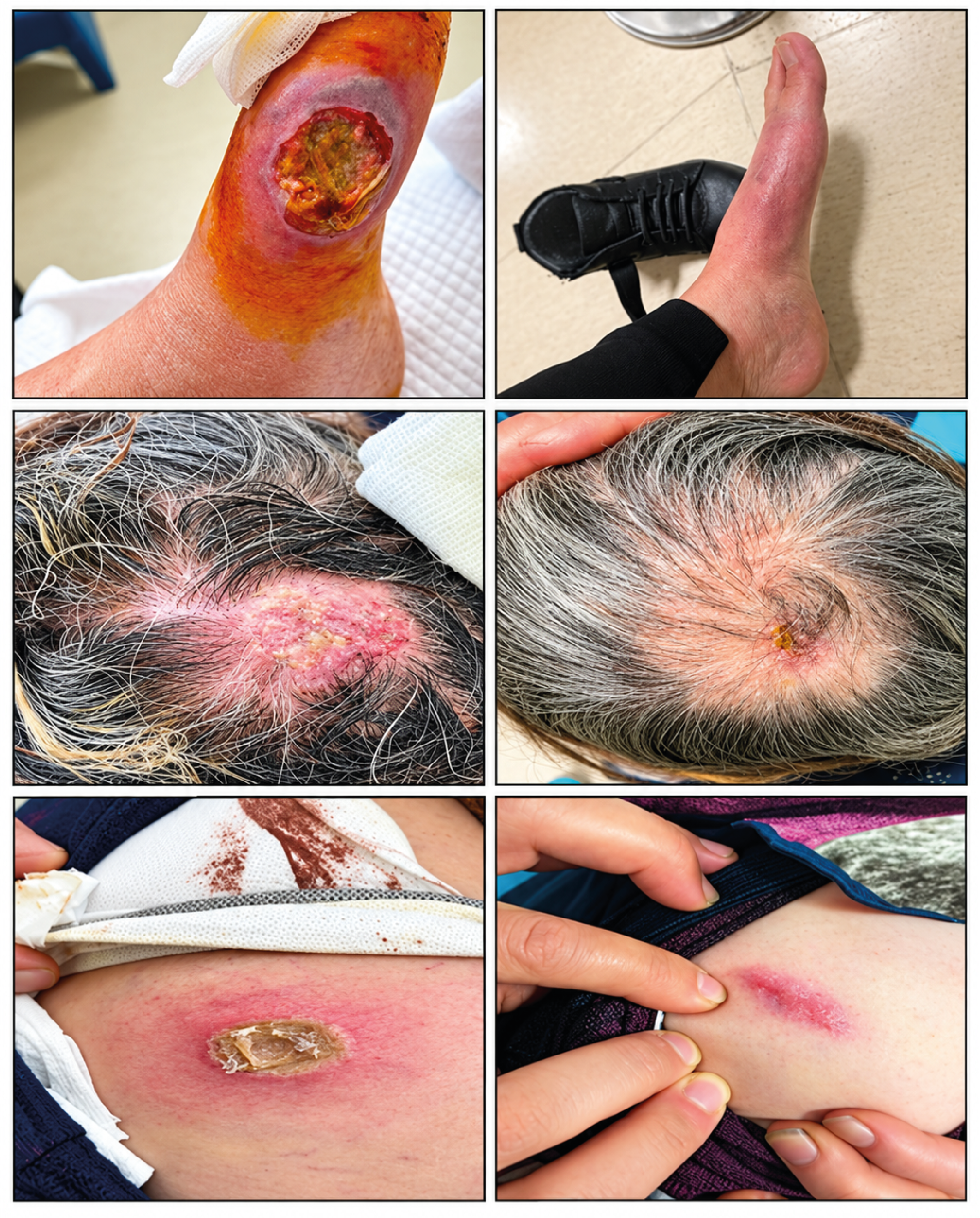Figure 1. Pyoderma Gangrenosum Ulcerated Skin Lesions Before and After Treatment (On the Left and Right, Respectively) Appear to Have Completely Healed