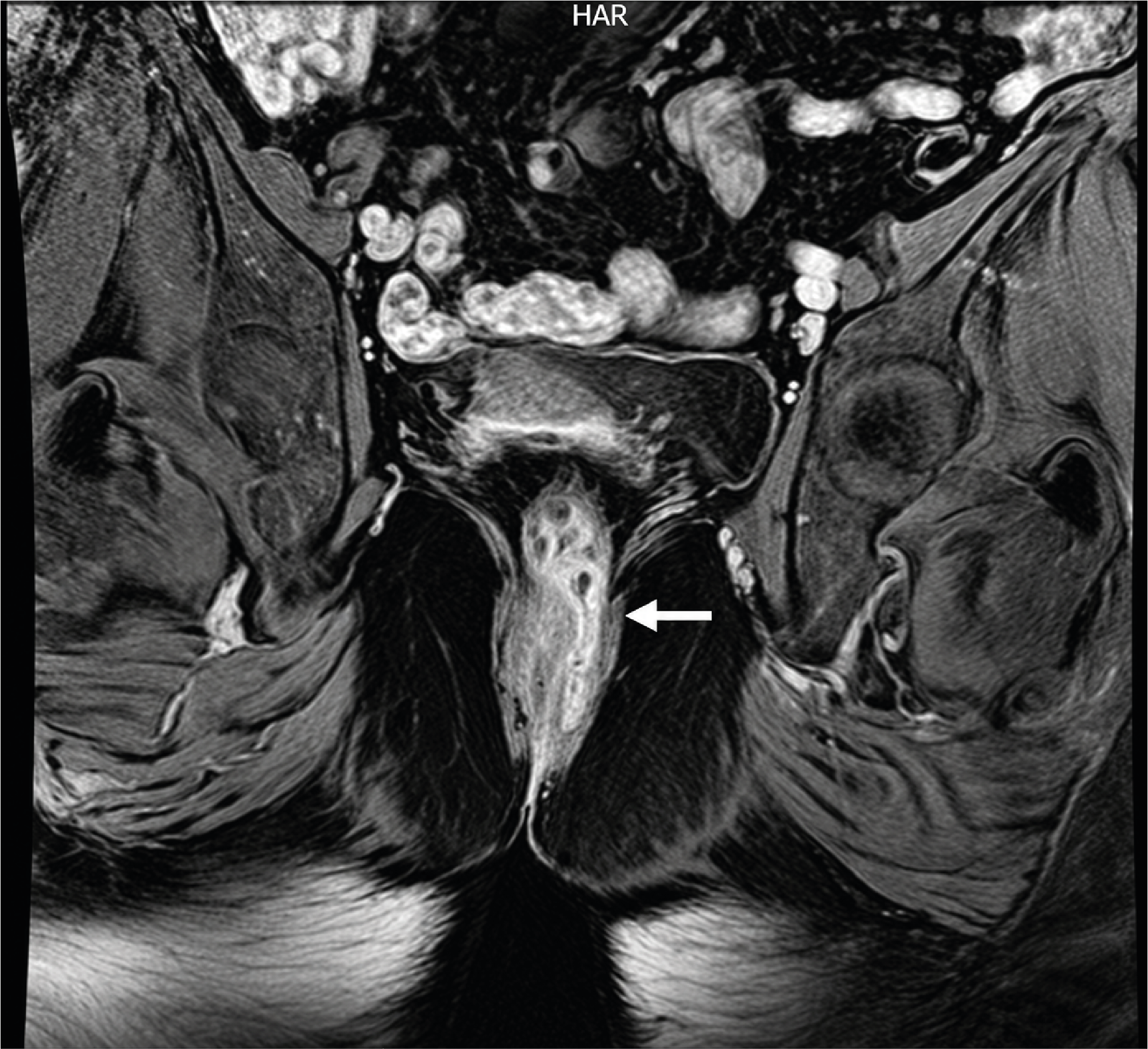 Figure 2. MRI Imaging Reveals the Presence of a Perianal Fistula Tract