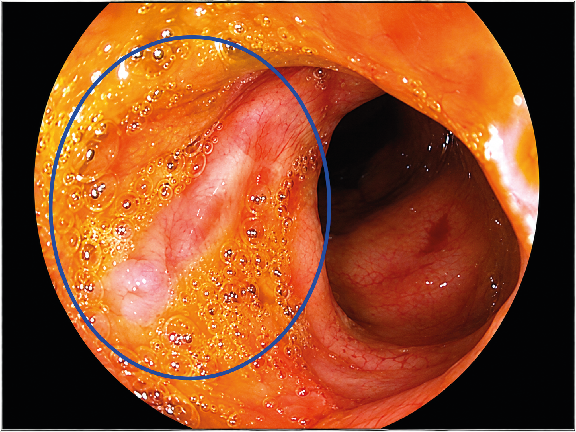 Figure 3. Colonoscopy Demonstrates the Presence of an Ulcer Adjacent to the Ileocecal Valve