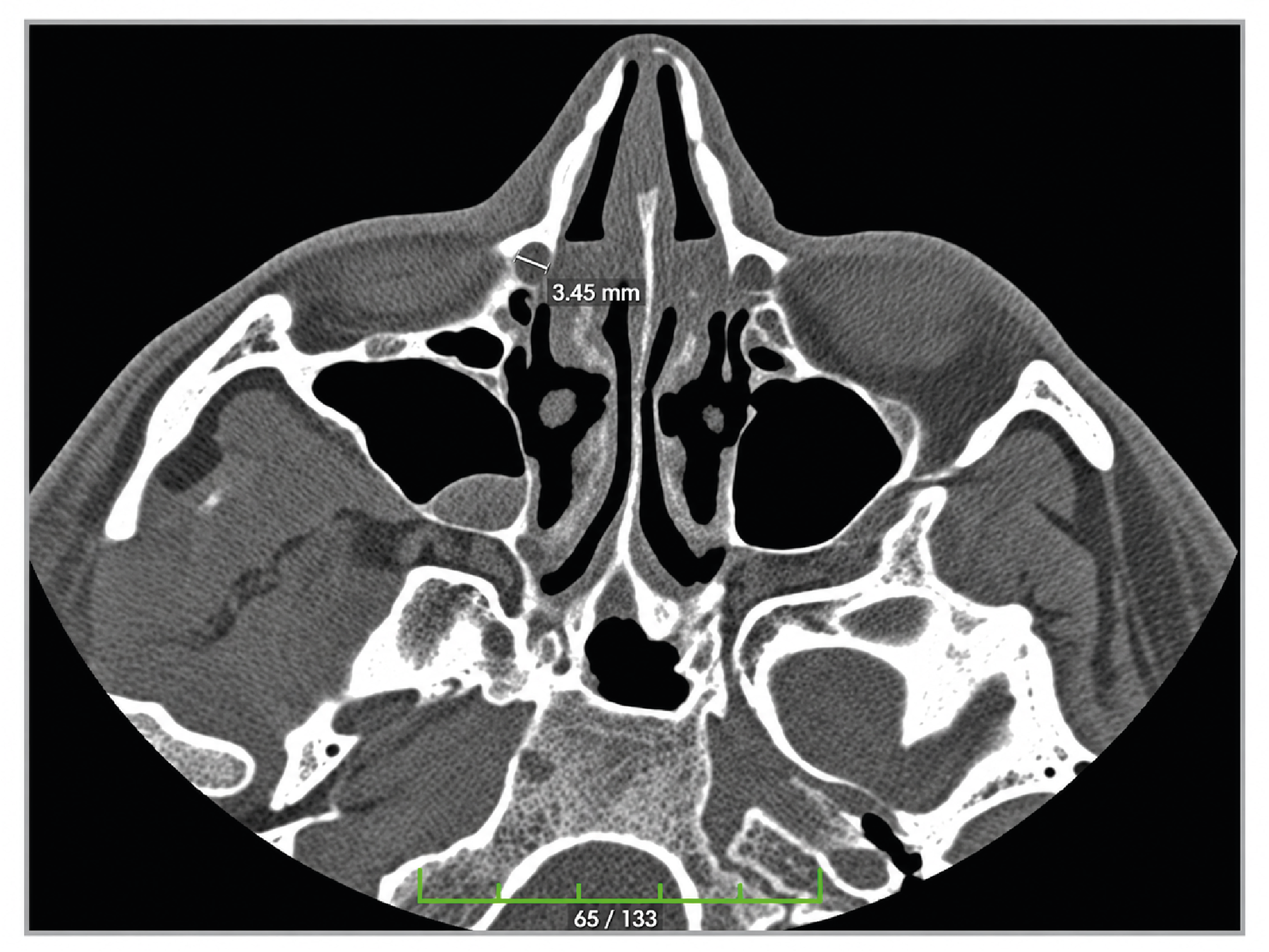 Figure 1. Axial Plane Ipsilateral Nasolacrimal Canal Transverse Diameter Measurements