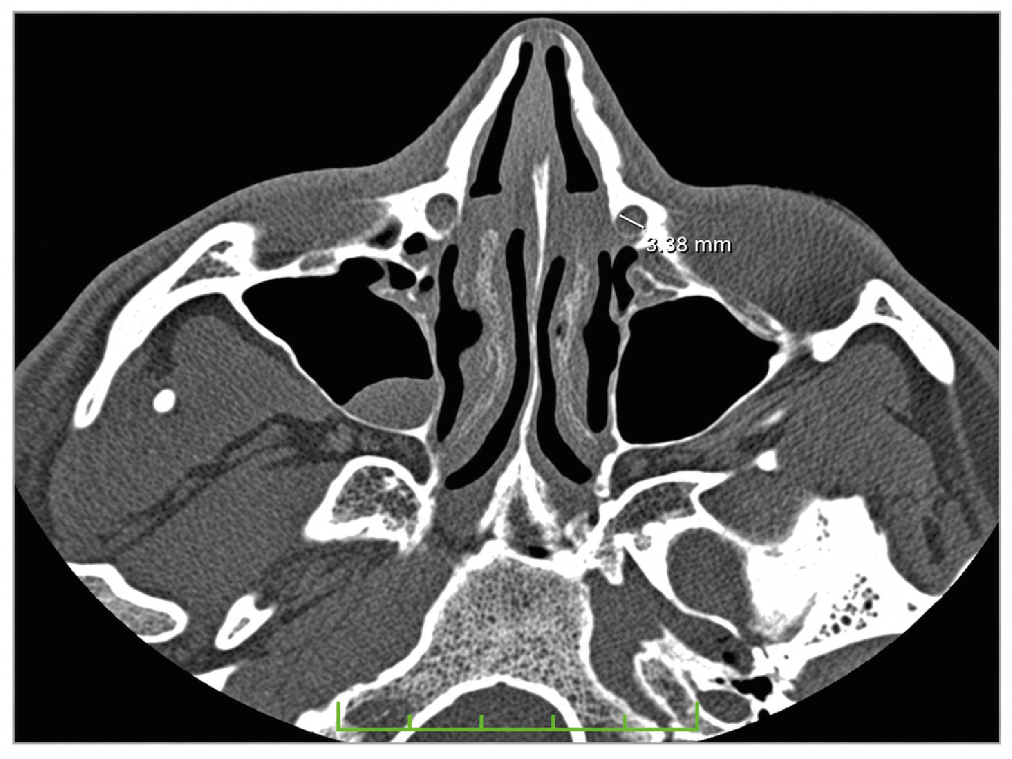 Figure 2. Contralateral Nasolacrimal Canal Transverse Diameter Measurement in the Axial Plane