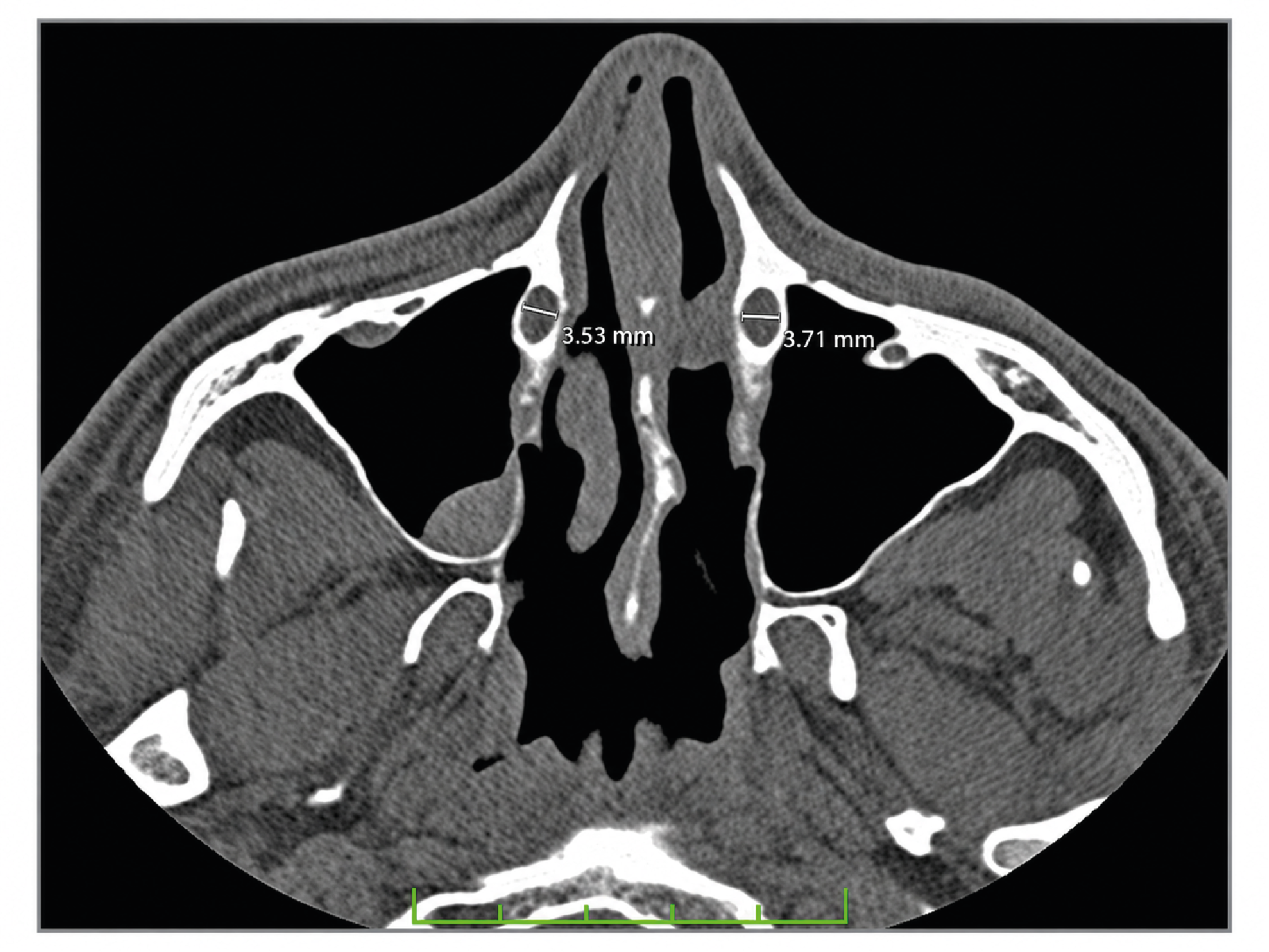 Figure 3. Ipsilateral and Contralateral Nasolacrimal Canal Transverse Diameter Measurement in the Distal Section