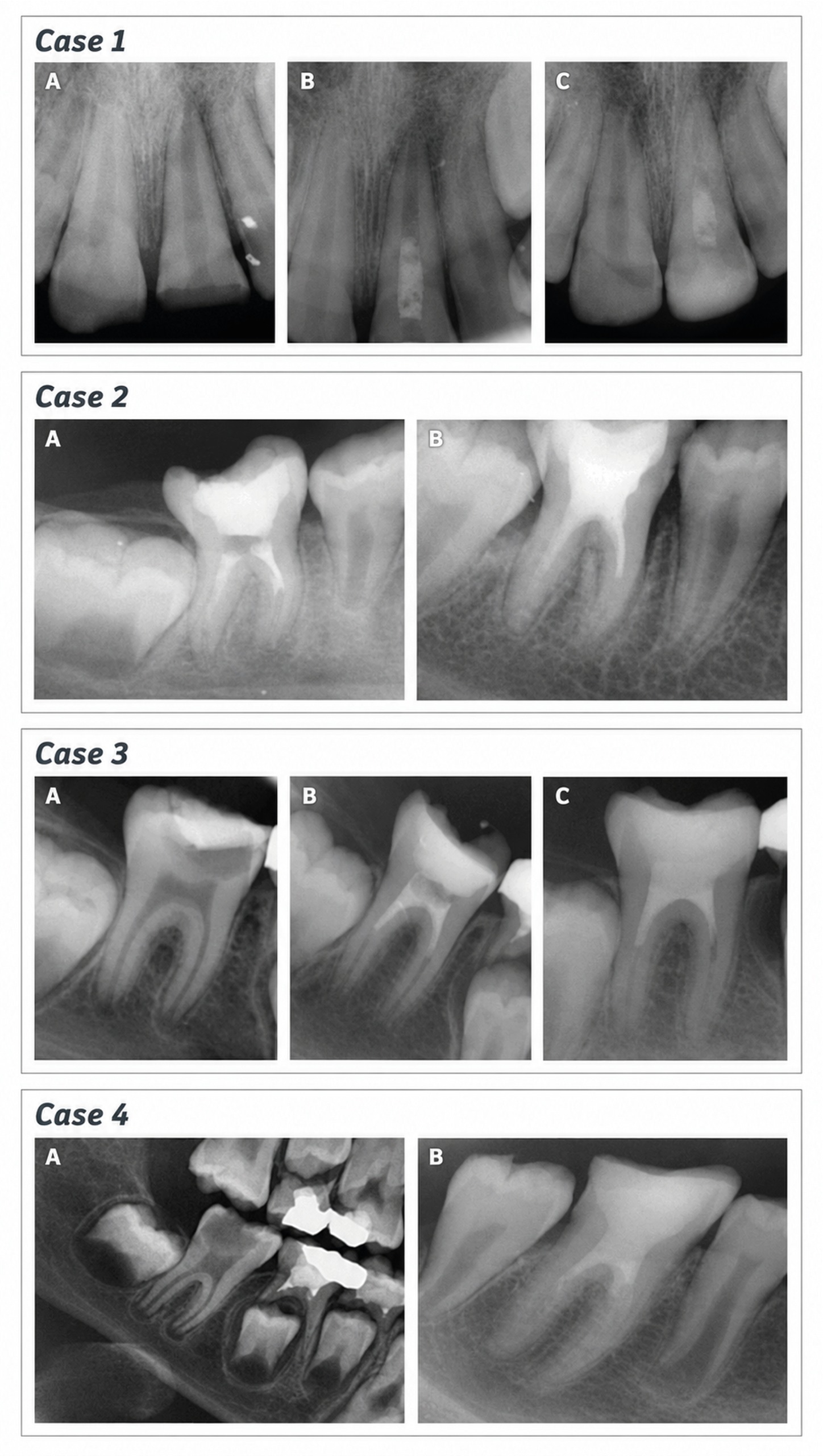 Figure 1. Complete healing category. Case 1. Maxillary right central incisor. Increased thickening of the canal walls and continued root maturation after revascularization; (A) Preoperative radiography. (B) Postoperative radiography. (C) Follow-up radiograph at 24 months. Case 2. Mandibular right first molar; (A) Preoperative radiography. (B) Follow-up radiograph at 24 months. Case 3. Mandibular right first molar; (A) Preoperative radiography. (B) Postoperative radiography. (C) Follow-up radiograph at 24 months. Case 4. Mandibular right first molar. (A) Preoperative radiography. (B) Follow-up radiograph at 24 months