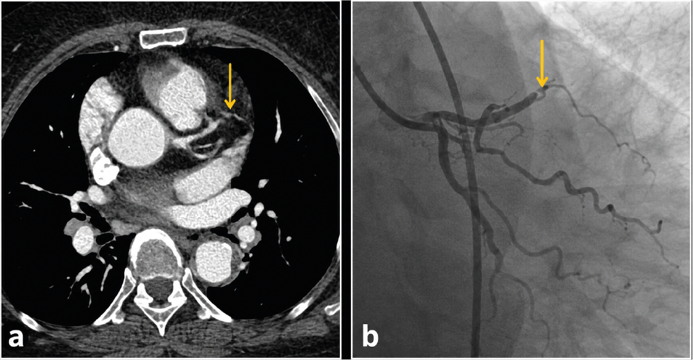 Figure 1. The thoracic computed tomography angiography image shows significant stenosis in the midsection of the left anterior descending (LAD) artery (a). Similarly, conventional coronary angiography image similarly shows 90% stenosis in the middle part of the LAD artery