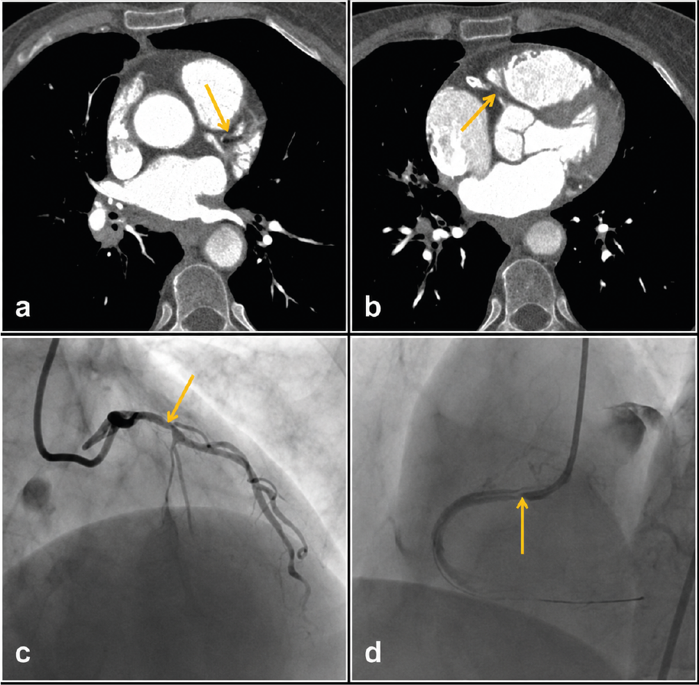 Figure 2. The thoracic computed tomography angiography image shows significant stenosis in the proximal left anterior descending (LAD) artery (a) and total occlusion in the right coronary artery (RCA) (b). Conventional coronary angiography image shows 70% stenosis in the LAD artery (c) and 90% stenosis in the RCA (d)