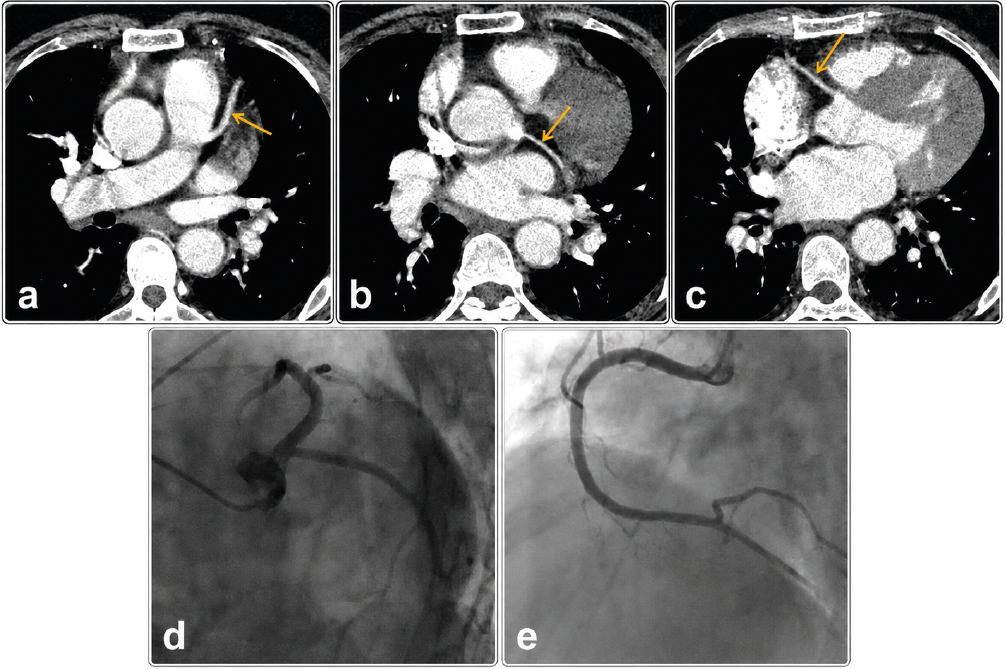 Figure 3. Thoracic computed tomography angiography images show normal findings in the left anterior descending artery (a), circumflex coronary artery (b), and the right coronary artery RCA (c), which are also confirmed to be normal by conventional coronary angiography (d, e)