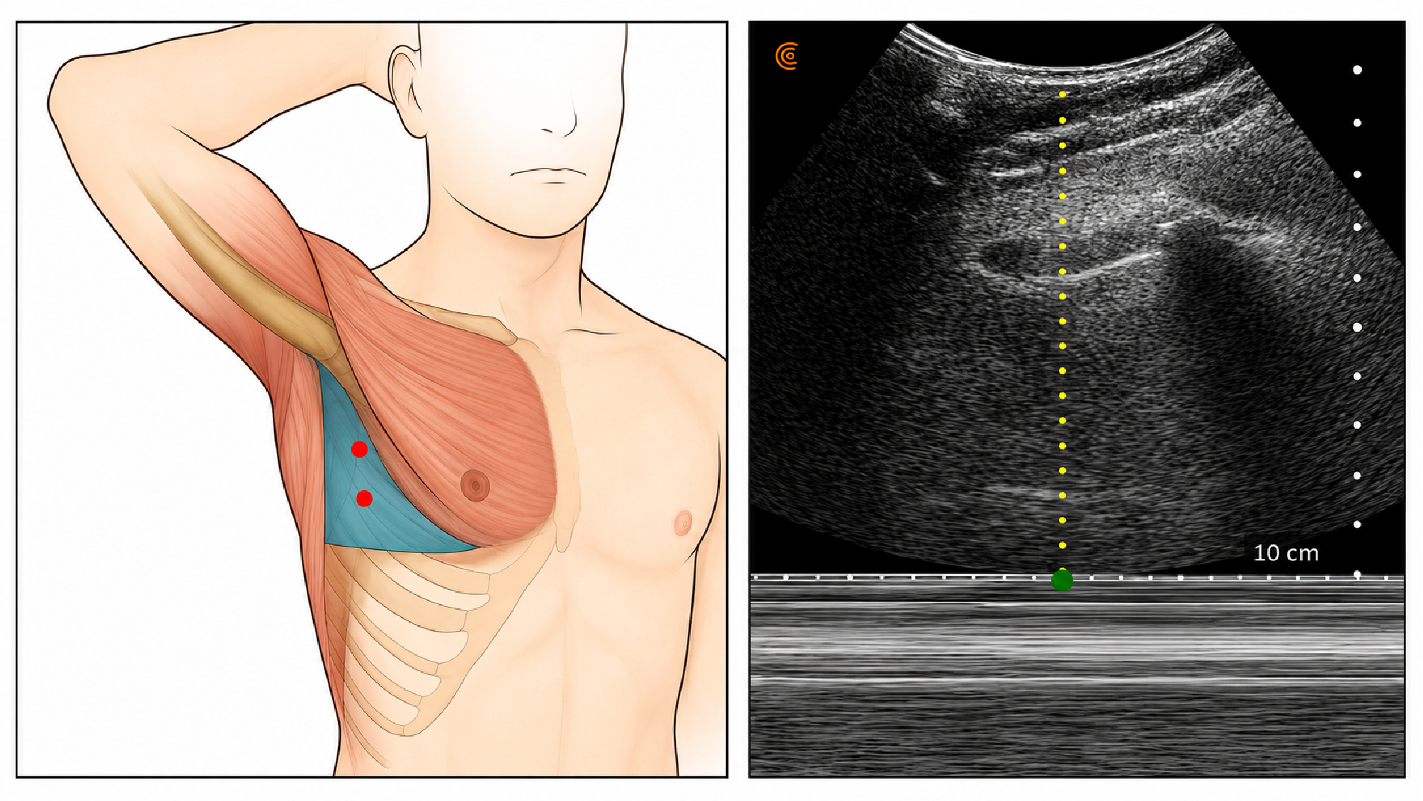 Figure 1. Anatomical landmark and thoracic ultrasound imaging demonstrating the ‘barcode sign’ indicative of pneumothorax with corresponding appropriate intervention site
