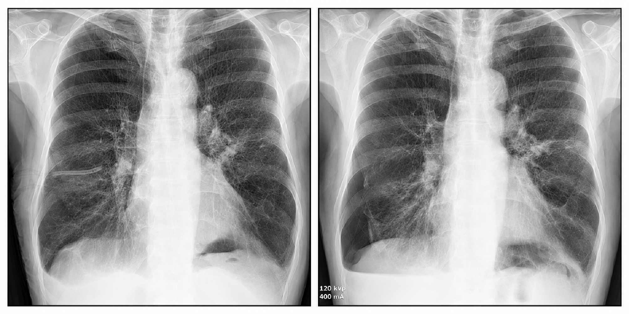 Figure 2. Right-sided pneumothorax: pre- and post-catheter insertion chest radiographs