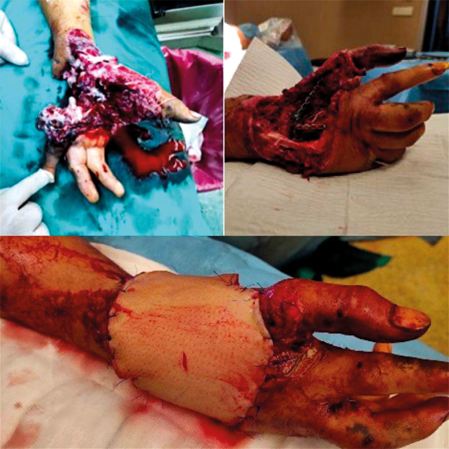 Figure 1. Free ALT flap application to the soft tissue defect in the volar forearm and early postop image. Preoperative image showing a soft tissue defect in the volar forearm following trauma. The intraoperative image demonstrates the preparation and application of the ALT flap for defect coverage. The early postoperative image shows the successful flap adaptation with viable tissue integration