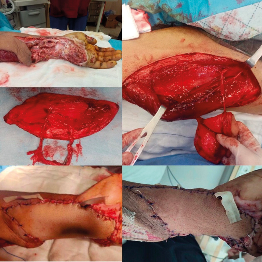 Figure 2. Step-by-step demonstration of ALT flap reconstruction in a patient with a volar forearm tissue defect. (A) Initial debridement of the defect site, (B) Identification and preparation of perforators of the ALT flap, (C) Harvested ALT flap before transfer, (D) Immediate postoperative view of the reconstructed forearm, (E) Long-term postoperative result showing stable coverage and good functional recovery