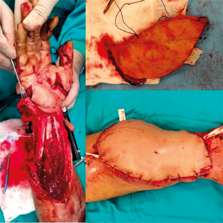 Figure 3. Stepwise representation of ALT flap application for a gunshot-induced soft tissue defect in the dorsal wrist. (A) Initial presentation of the tissue defect, (B) Post-debridement and bone fixation phase, (C) Immediate postoperative appearance following ALT flap reconstruction, (D) Long-term postoperative outcome demonstrating stable coverage and functional preservation