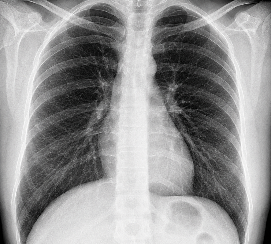 Figure 1. Posteroanterior chest radiograph showed no apparent abnormalities