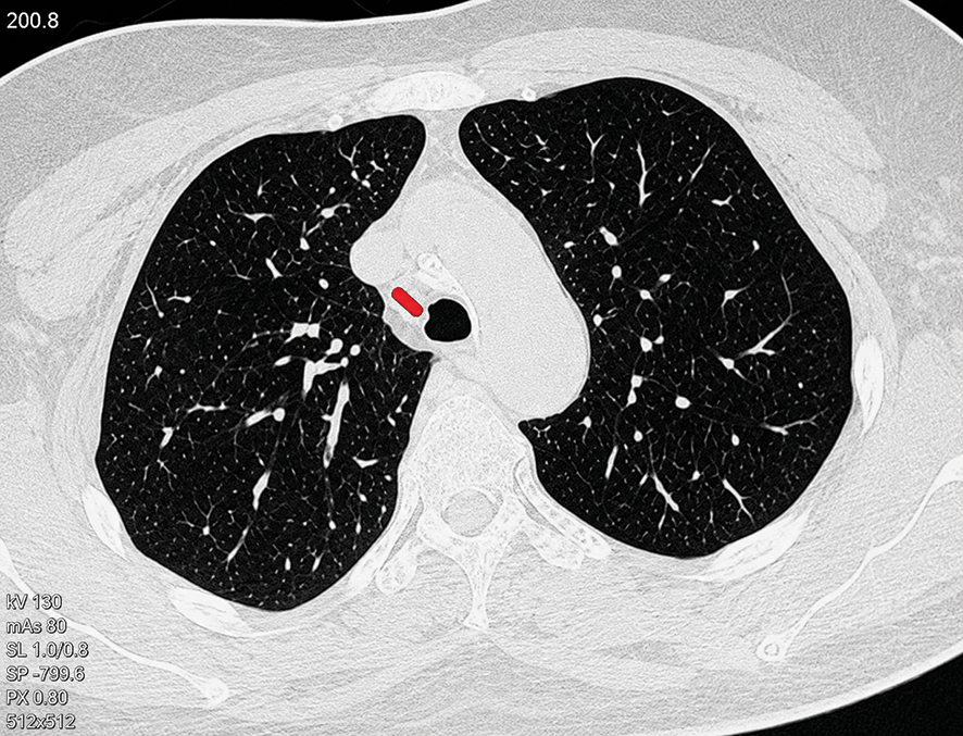 Figure 3. PET-CT scan showed pathological metabolic activity in the lesion and mildly increased metabolic activity in cervical and hilar lymph nodes