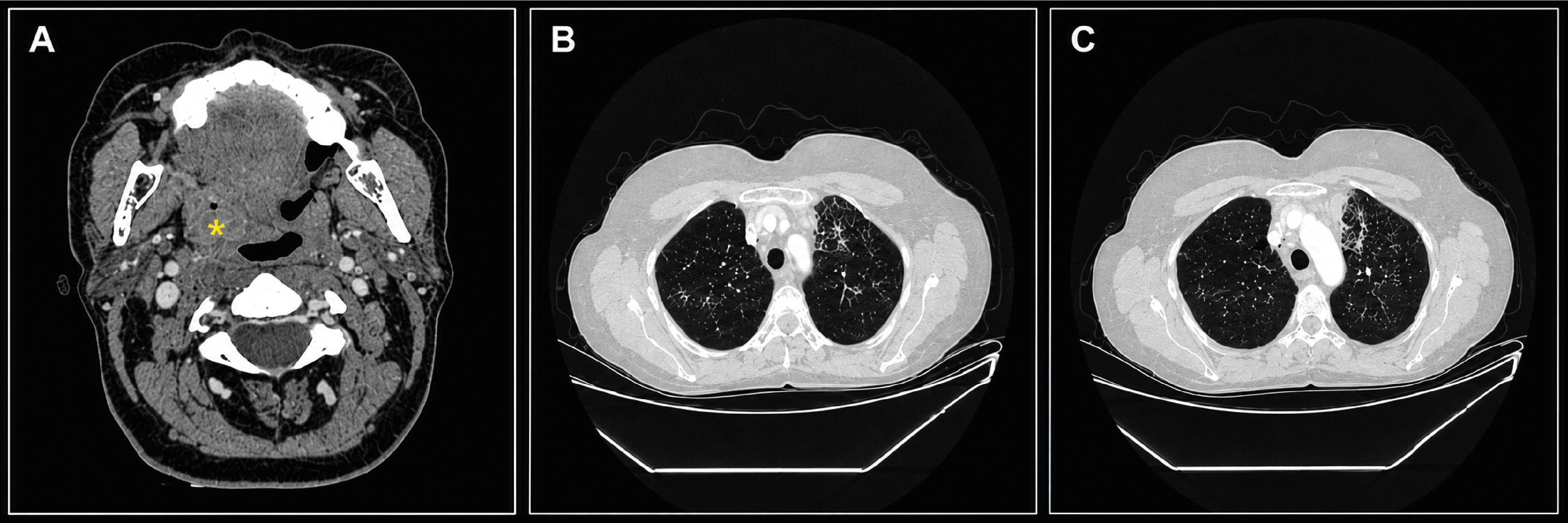Figure 1. A: Mass lesion visible in the oropharynx on neck computed tomography (CT) FIGURE B AND C: Common tree in bud appearances in lung parenchyma regions on thorax