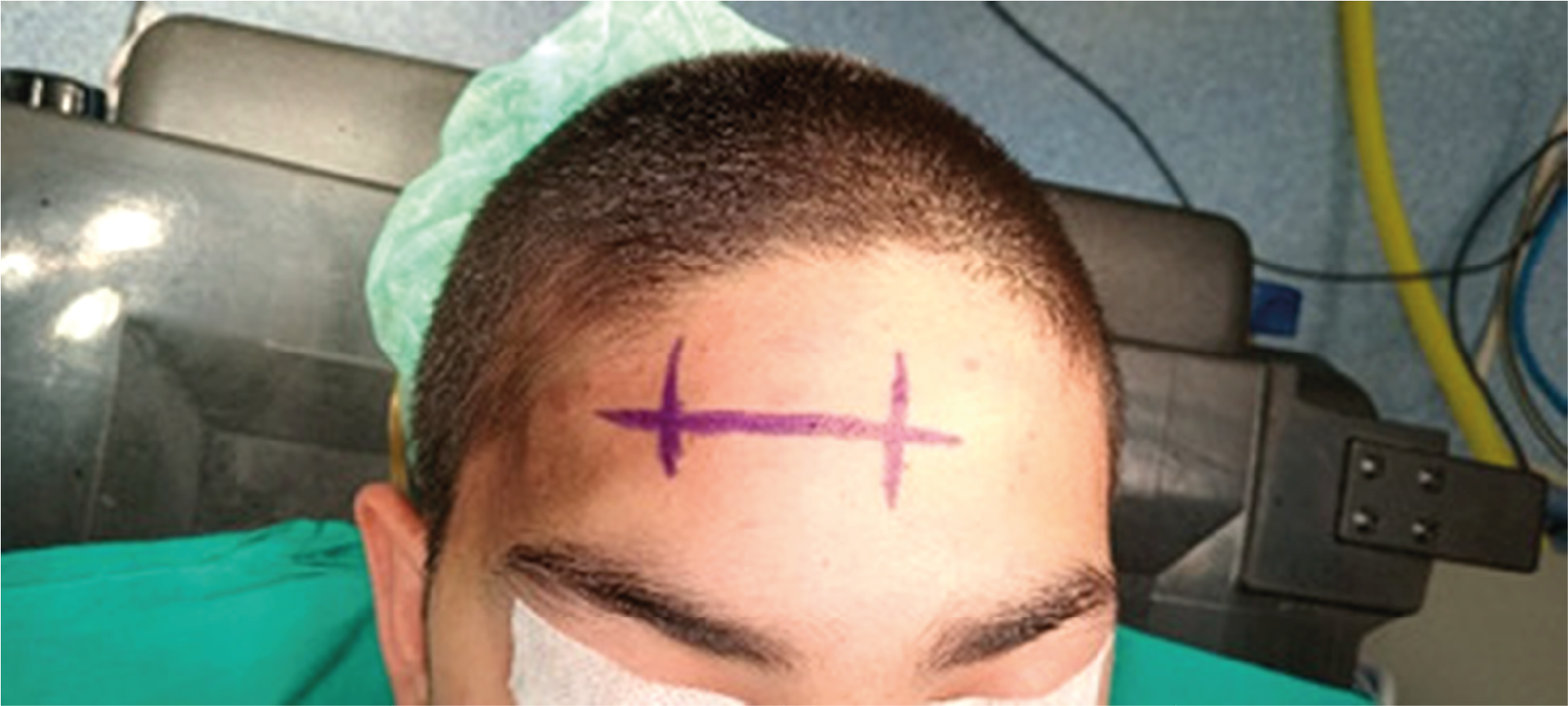Figure 1. Localization of the soft tissue swelling on the skin of the forehead
