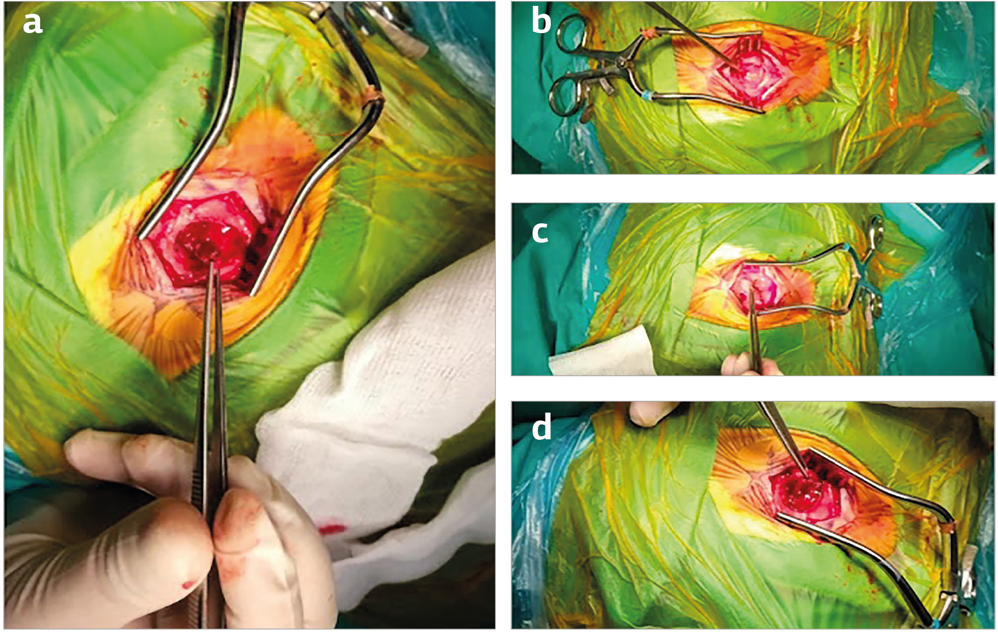 Figure 3. Surgical resection