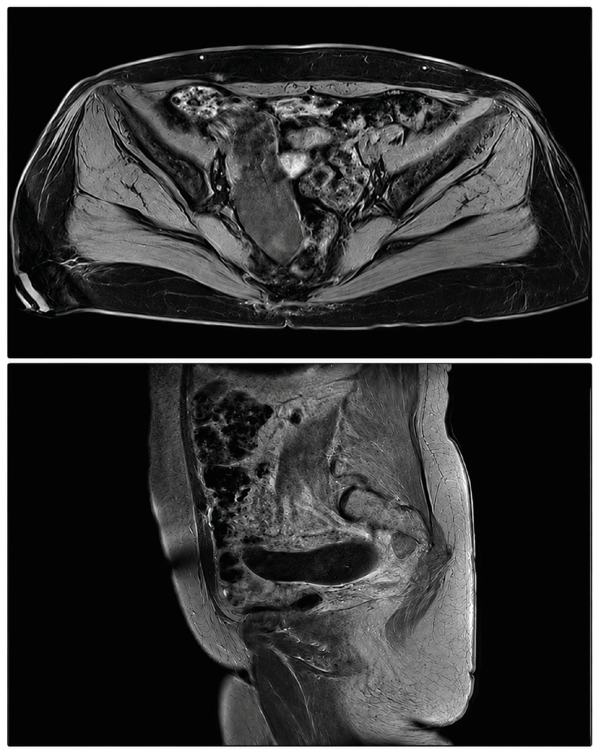 Figure 1. Appendiceal mucocele CT image