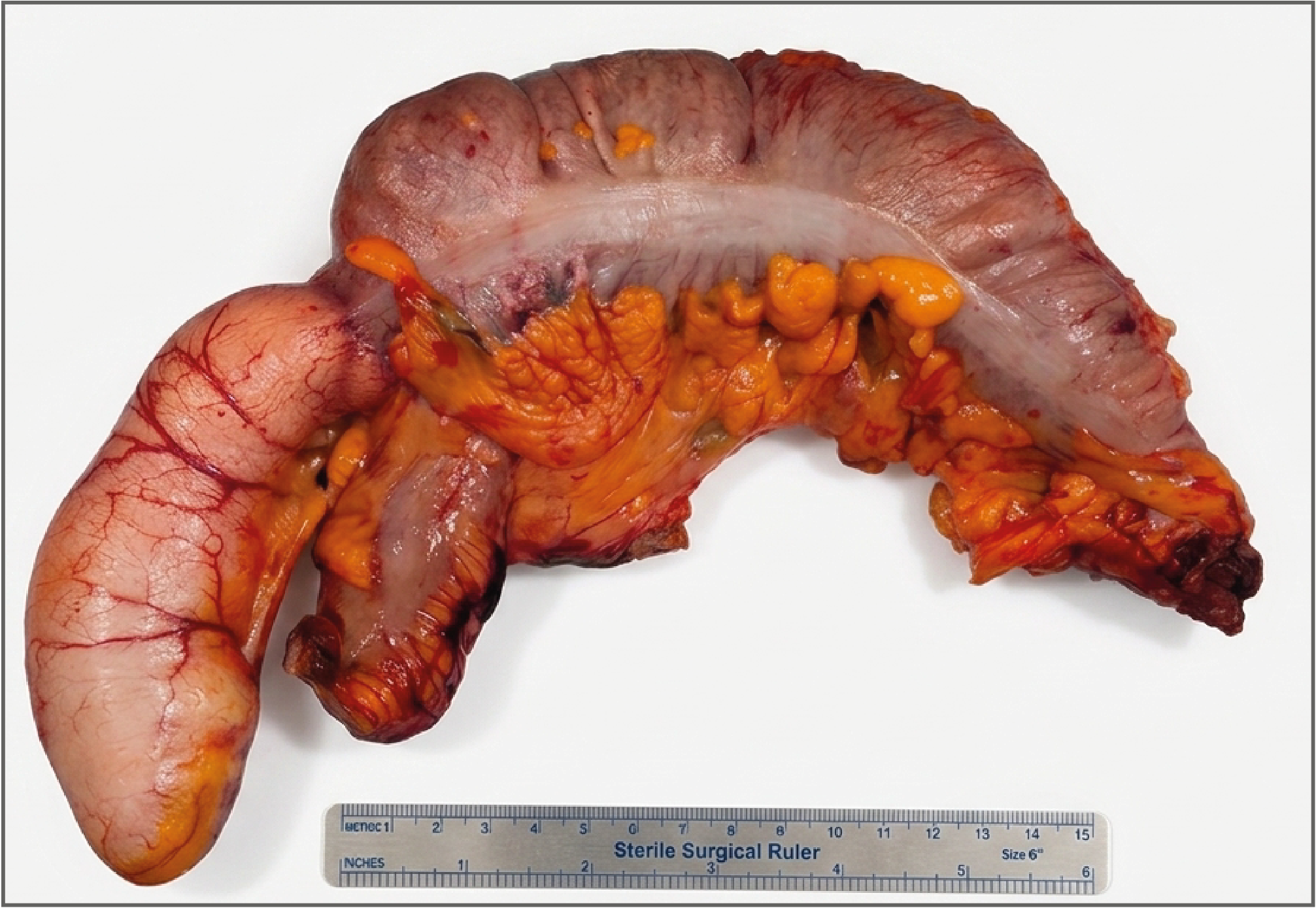 Figure 2. Appendiceal mucocele and right hemicolectomy specimen