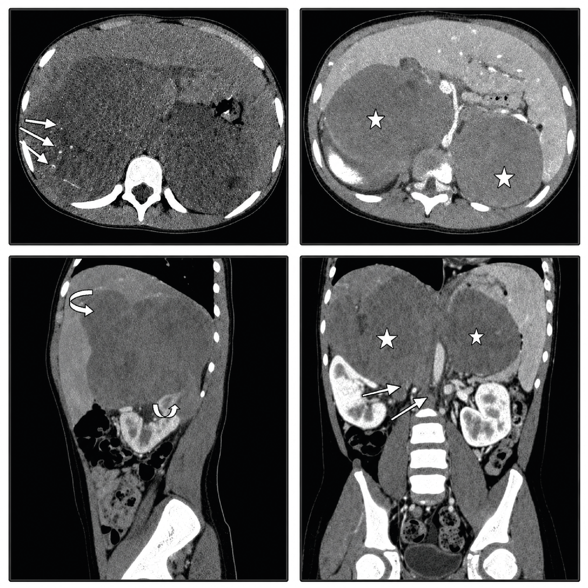 Figure 1. Abdominal CT scan with contrast
