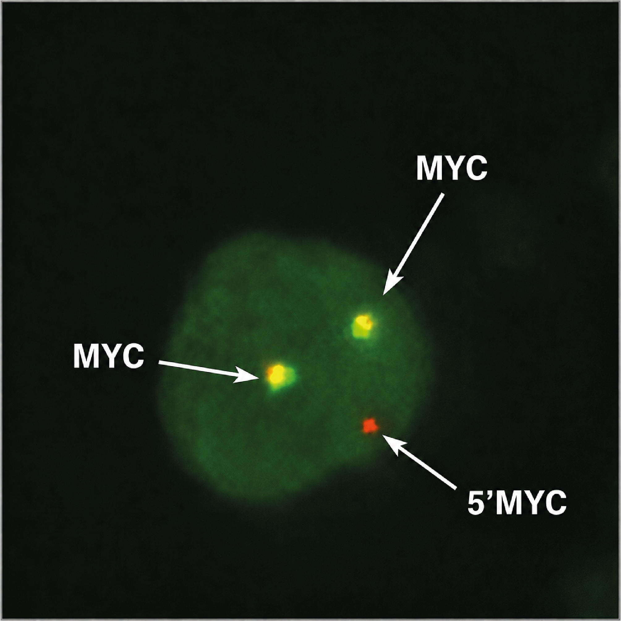 Figure 3. Gain 5’MYC on FISH test