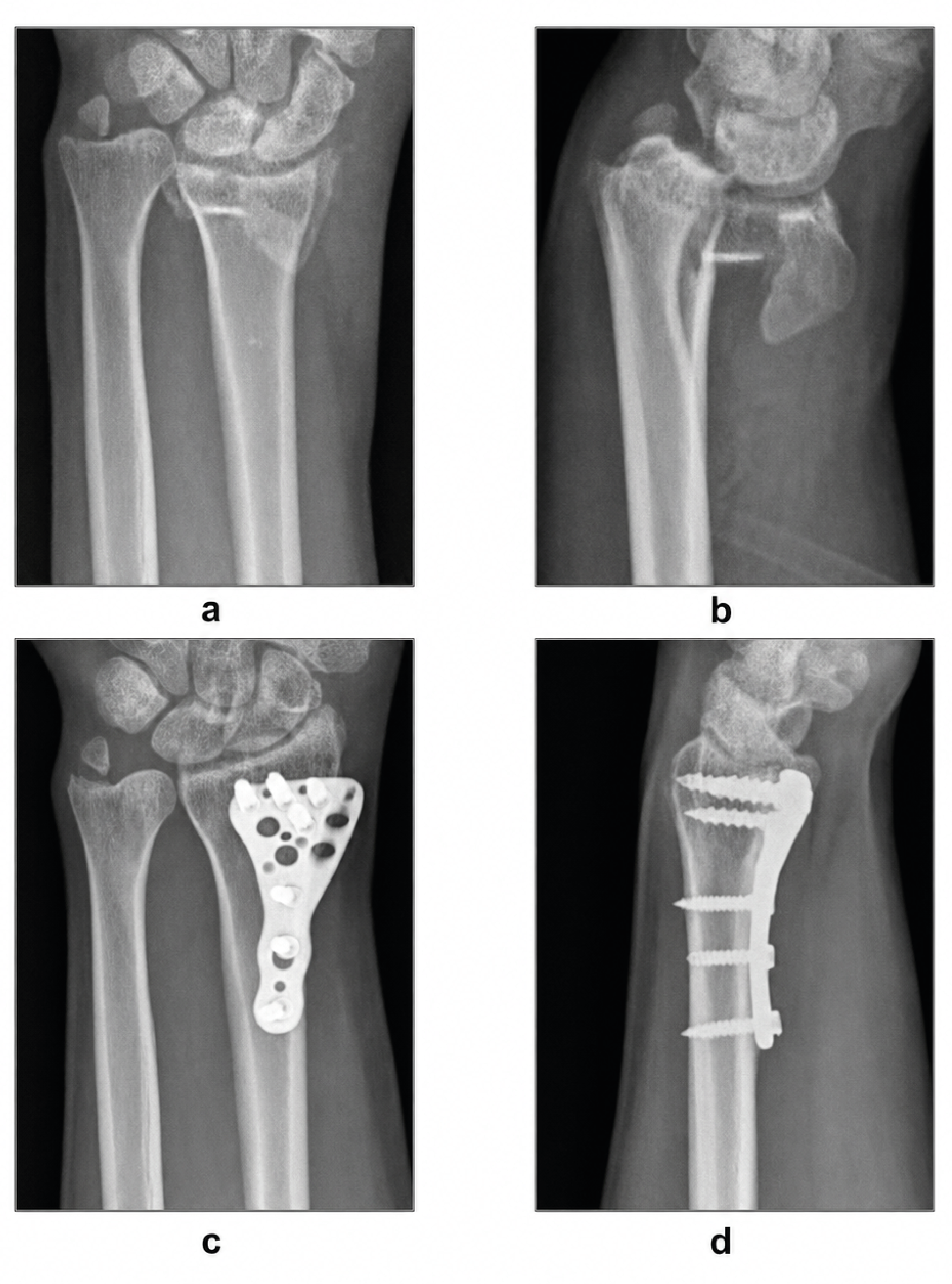 Figure 3. Preoperative (left) and postoperative (right) anteroposterior and lateral wrist radiographs of a 59-year-old female patient (Frykman type 4, AO type B2). (a) preoperative anteroposterior radiograph showing intra-articular and dorsally angulated distal radius fracture. (b) preoperative lateral radiograph demonstrating dorsal displacement and cortical comminution. (c) postoperative AP radiograph after volar locking plate fixation, showing restoration of radial height and articular congruency. (d) postoperative lateral view demonstrating correction of dorsal angulation and stable fixation with subchondral support