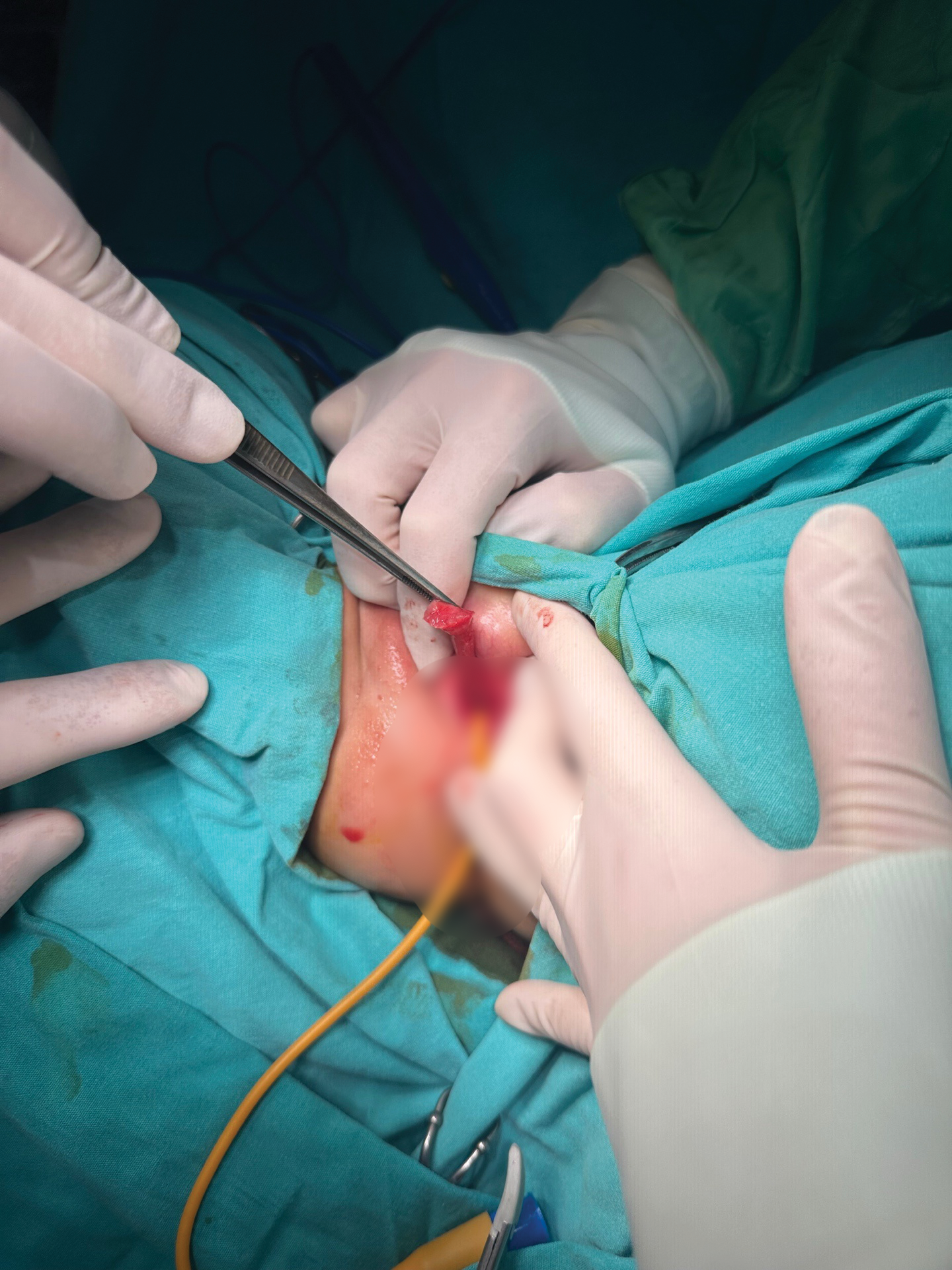Figure 1. Intraoperative View of the Pedunculated Fibroepithelial Polyp Originating from the Distal Urethral Meatus