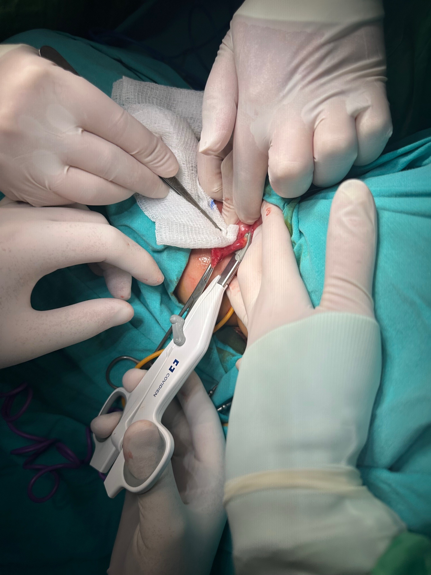 Figure 2. Intraoperative View Showing the Surgical Excision of the Polyp Base Using a Vessel-Sealing Device